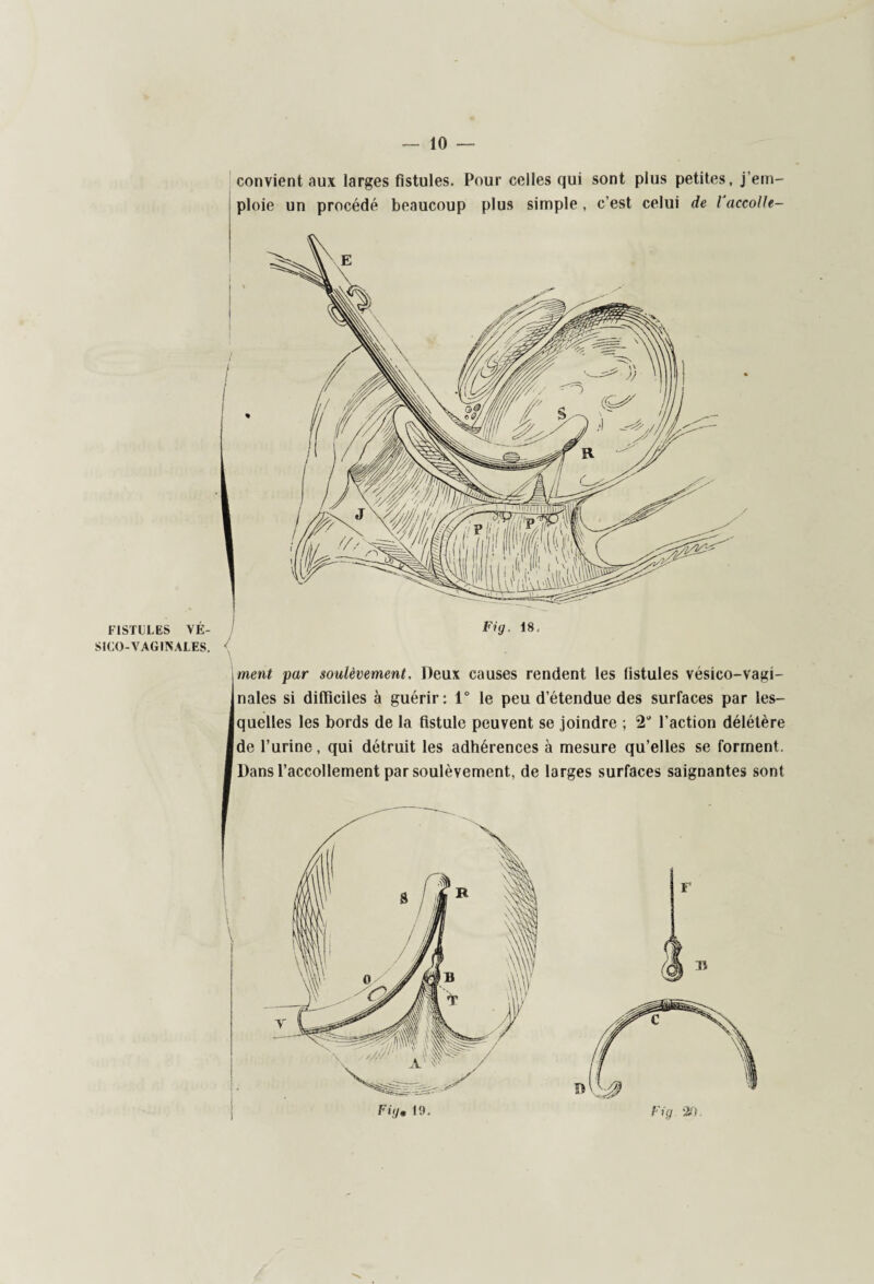 FISTULES VÉ- SICO-VAGINALES. convient aux larges fistules. Pour celles qui sont plus petites, j'em¬ ploie un procédé beaucoup plus simple , c’est celui de ïaccolle- Fig. 18, ment par soulèvement, Deux causes rendent les fistules vésico-vagi¬ nales si difficiles à guérir: 1° le peu d’étendue des surfaces par les¬ quelles les bords de la fistule peuvent se joindre ; 2“ l’action délétère de l’urine, qui détruit les adhérences à mesure qu’elles se forment. Dans l’accollement par soulèvement, de larges surfaces saignantes sont