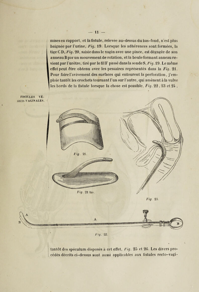 mises en rapport, et la fistule, relevee au-dessus du bas-fond, n’est plus baignée par l’urine, Fig. 19. Lorsque les adhérences sont formées, la tige C D, Fig. 20, saisie dans le vagin avec une pince, est dégagée de son anneau B par un mouvement de rotation, et la boule formant anneau re¬ vient par l’urètre, tiré par le fil F passé dansla sondeS, Fig. 19. Le même effet peut être obtenu avec les pessaires représentés dans la Fig. 21. Pour faire l’avivement des surfaces qui entourent la perforation, j’em¬ ploie tantôt les crochets tournant l’un sur l’autre, qui amènent à la vulve les bords de la fistule lorsque la chose est possible, Fig. 22,23 et 24 , FISTULES VÉ- SICO-V AGÎN ALES. < Fig 21 bis. tantôt des spéculum disposés à cet effet, Fig. 25 et 26. Les divers pro¬ cédés décrits ci-dessus sont, aussi applicables aux fistules recto-vagi-