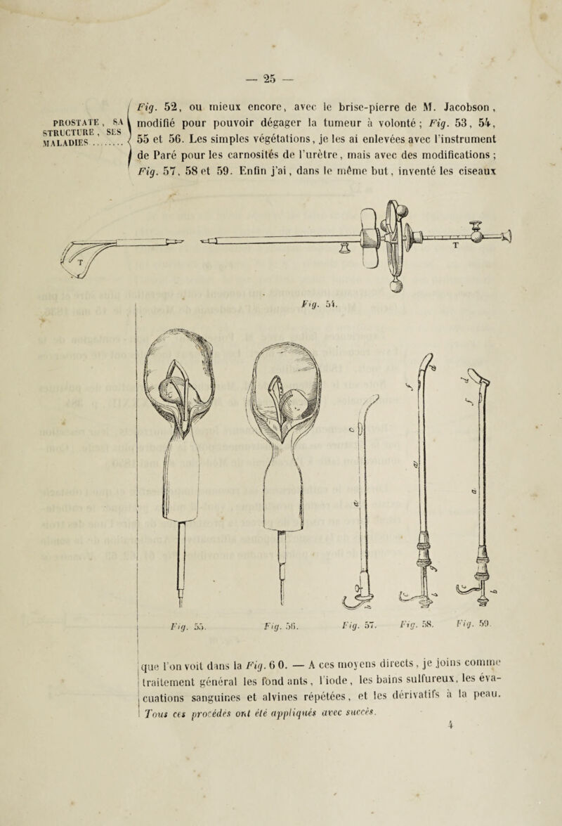 PROSTATE, SA STRUCTURE, SES MALADIES . Fig. 52, ou mieux encore, avec le brise-pierre de M. Jacobson , modifié pour pouvoir dégager la tumeur à volonté; Fig. 53, 54, 55 et 56. Les simples végétations, je les ai enlevées avec l'instrument de Paré pour les carnosités de l’urètre, mais avec des modifications ; Fig. 57, 58 et 59. Enfin j’ai, dans le même but, inventé les ciseaux que l’on voit dans la Fig. 6 0. — A ces moyens directs, je joins connm traitement général les fond ants, 1 iode, les bains sulfureux, les éva¬ luations sanguines et alvines répétées, et les dérivatifs a la peau. 1 Tous ces procèdes ont été appliqués avec succès. 4