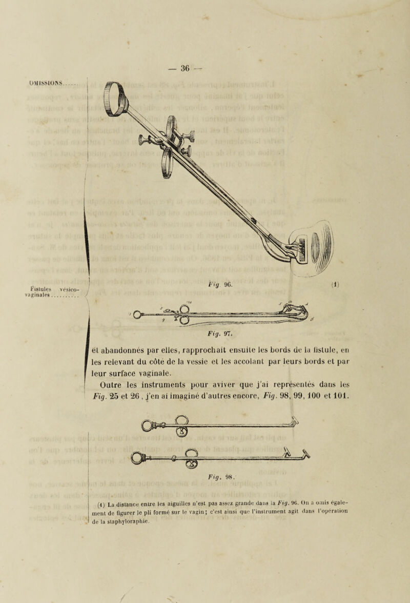 OMISSIONS Fistules vésico- vaginales. el abandonnés par elles, rapprochait ensuile les bords de la lislule, en les relevant du côte de la vessie et les accolant par leurs bords et par leur surface vaginale. Outre les instruments pour aviver que j’ai représentés dans les Fig. 25 et 26 , j’en ai imaginé d’autres encore, Fig. 98, 99, J00 et 101. Fig. 98.- (\) La distance entre les aiguilles n’est pas assez grande dans la Fig. 96. On a omis égale¬ ment de figurer Je pli formé sur le vagin; c’est ainsi que l’instrument agit dans l’opération de la staphyloraphie.