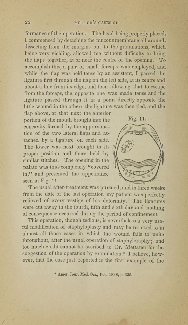 formance of the operation. The head being properly placed, I commenced by detaching the mucous membrane all around, dissecting from the margins out to the granulations, which being very yielding, allowed me without difficulty to bring the flaps together, at or near the centre of the opening. To accomplish this, a pair of small forceps was employed, and while the flap was held tense by an assistant, I passed the ligature first through the flap on the left side, at its centre and about a line from its edge, and then allowing that to escape from the forceps, the opposite one was made tense and the ligature passed through it at a point directly opposite the little wound in the other; the ligature was then tied, and the flap above, or that next the anterior portion of the mouth brought into the Fig* 11- concavity formed by the approxima¬ tion of the two lateral flaps and at¬ tached by a ligature on each side. The lower was next brought to its proper position and there held by similar stitches. The opening in the palate was thus completely “covered in,” and presented the appearance seen in Fig. 11. The usual after-treatment was pursued, and in three weeks from the date of the last operation my patient was perfectly relieved of every vestige of his deformity. The ligatures were cut away in the fourth, fifth and sixth day and nothing of consequence occurred during the period of confinement. This operation, though tedious, is nevertheless a very use¬ ful modification of staphyloplasty and may be resorted to in almost all those cases in which the wound fails to unite throughout, after the usual operation of staphyloraphy; and too much credit cannot be ascribed to Dr. Mettauer for the suggestion of the operation by granulation.* I believe, how¬ ever, that the case just reported is the first example of the * Aracr. Jour, Med. Sci., Feb. 1838, p. 335.