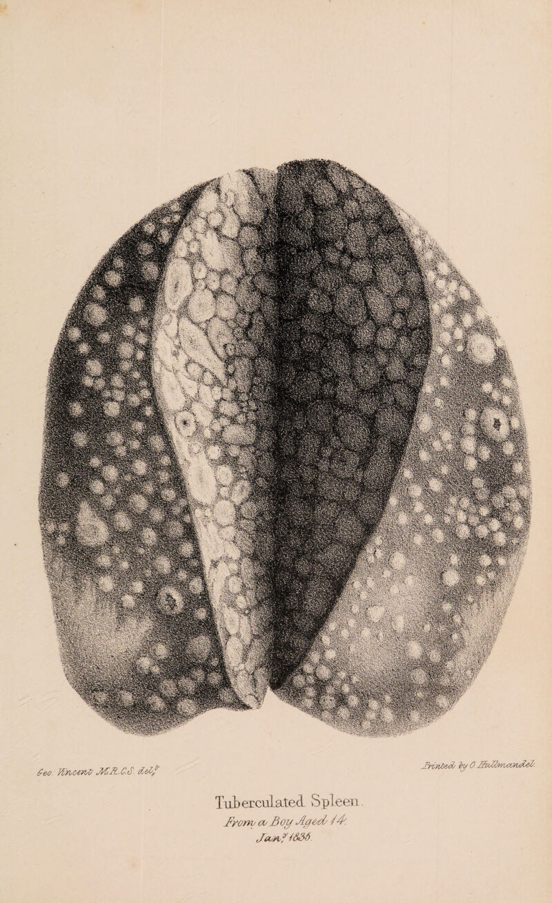 £eo Jftws&eavfr M.U.C.S- d-e/tf TuberculatecL Spleen . .From/ oi/ fioif Jtci&d/ /F. JanftdM.