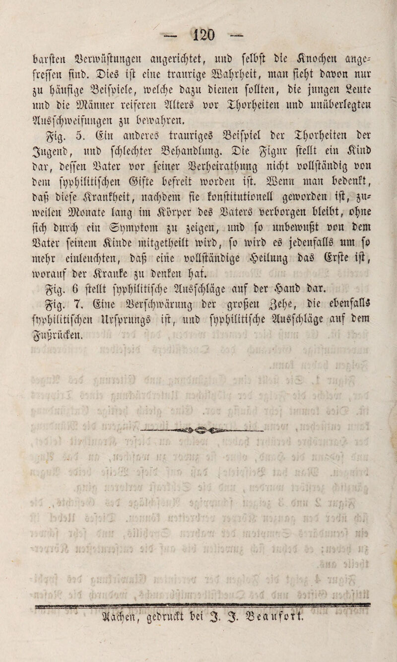 barjten Berwüftuugeu augcridpet, unb felbft bie Änocpeu auge- freffeit ftnb. £)ieS ift cine traurige 3BaJ>rI;eit, man pept bauen nur ju püuftge Betfpiele, welcpe baju bienen füllten, bie jungen Sente unb bie Männer reiferen BlterS «or £|orpeiten unb unüberlegten QluSfcpweifungen 5it bewahren. gig. 5. (Sin anbereS trauriges Beifptel ber Xporpeiten ber 3ugeub, unb fcplecpter Bepaublung. Die glgitr jiellt ein Äinb bar, beffen Bater uor feiner Berpeiratpung nid;t Dollftänbig non bent fpppilitifepen ©ifte befreit worben ift. SBenn man bebentt, baft btefe ^ranfpeit, naepbent fie fonpitutionell geworben ip, ju* weilen donate tang im Körper beS BaterS «erborgen bteibt, cpne pep buret) ein ©pmptem ju feigen, unb fo unbewupt non bent Bat er feinem $inbe mitgetpeüt wirb, fo wirb eS {ebenfalls um fo ntepr eiuleuepten, baft eine Düßpänbige Leitung baS (Srpe ip, worauf ber Pr ante 51t beuten f)at. gig. 6 petit fpppilitifepe 21uSfcpläge auf ber £anb bar, gig. 7. (Sine Berfcpwärmtg ber gropett $epe, bie ebenfalls fpppüitifcpcu HrfpntngS ip, unb fpppilitifcpe 51uSfcpläge auf bem gupriufen. Aachen, gebruett bei 3- 3* Beaufort. fit fl