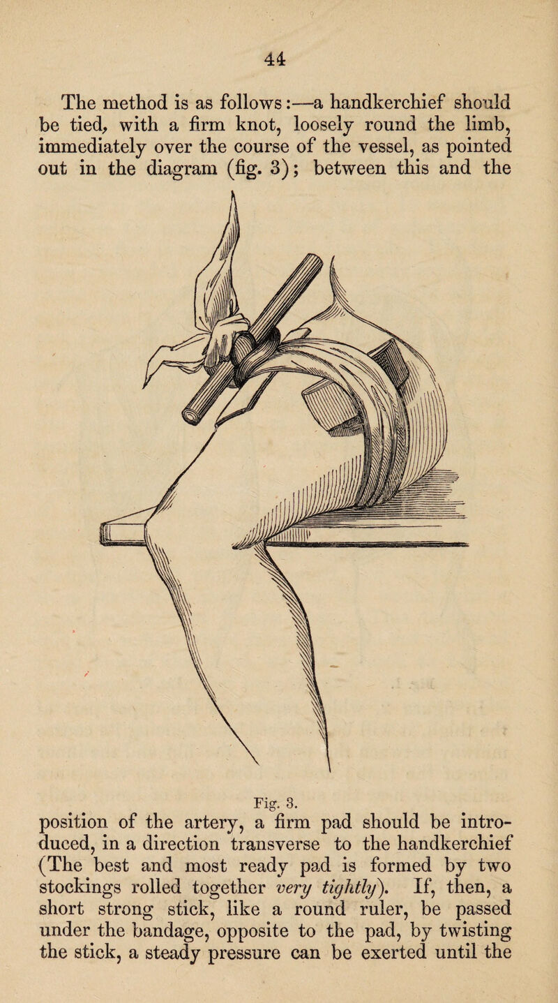 The method is as follows:—a handkerchief should be tied, with a firm knot, loosely round the limb, immediately over the course of the vessel, as pointed out in the diagram (fig. 3); between this and the Fig. 3. position of the artery, a firm pad should be intro¬ duced, in a direction transverse to the handkerchief (The best and most ready pad is formed by two stockings rolled together very tightly). If, then, a short strong stick, like a round ruler, be passed under the bandage, opposite to the pad, by twisting the stick, a steady pressure can be exerted until the