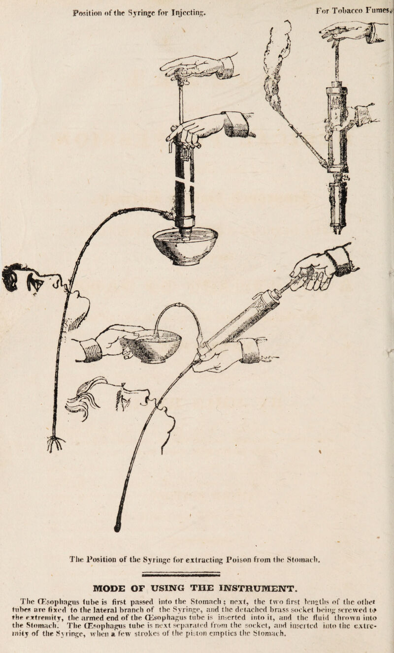 The Position of the Syringe for extracting Poison from the Stomach. MODE OF USING THE INSTRUMENT. The (Esophagus tube is first passed into the Stomach ; next, the two first lengths of the othe* tubes are fixed to the lateral branch of the Syringe, and the detached brass socket being screwed to ♦ he extremity, the armed end of the (Esophagus tube is inserted into it, and the fluid thrown into the Stomach. The (Esophagus tube is next separated from the socket, and inserted into the extre¬ mity of the Syringe, when a few strokes of the piston empties the Stomach.