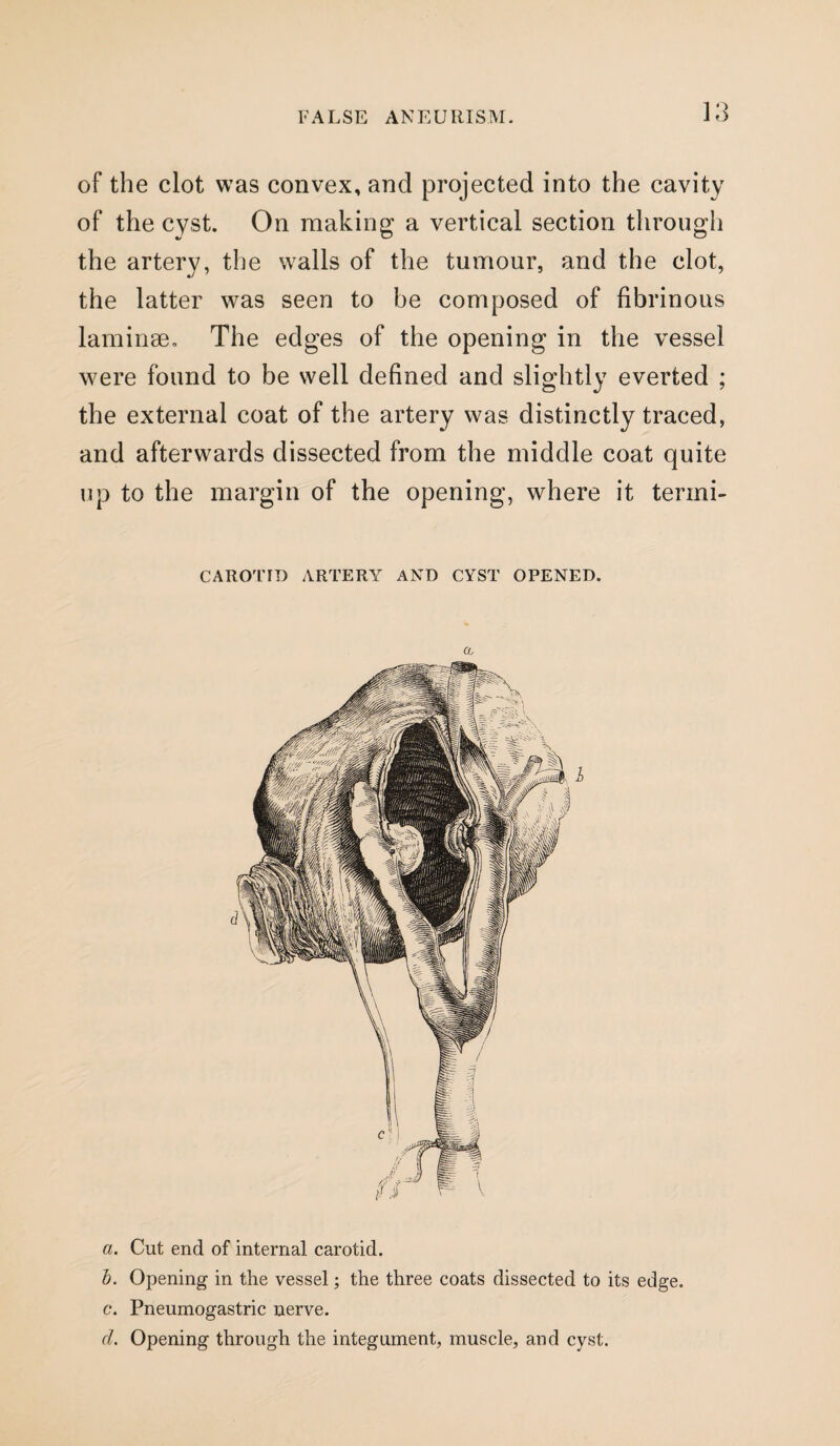 of the clot was convex, and projected into the cavity of the cyst. On making a vertical section through the artery, the walls of the tumour, and the clot, the latter was seen to be composed of fibrinous laminae. The edges of the opening in the vessel were found to be well defined and slightly everted ; the external coat of the artery was distinctly traced, and afterwards dissected from the middle coat quite up to the margin of the opening, where it termi- CAROTID ARTERY AND CYST OPENED. a. Cut end of internal carotid. b. Opening in the vessel; the three coats dissected to its edge. c. Pneumogastric nerve. d. Opening through the integument, muscle, and cyst.