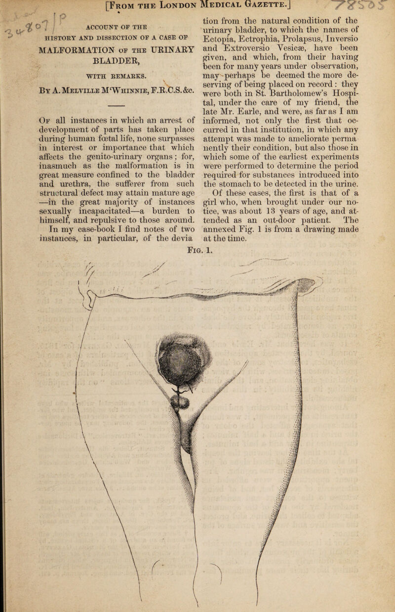 Medical Gazette.J ' 7 X ;' ) tion from the natural condition of the urinary bladder, to which the names of Ectopia, Ectrophia, Prolapsus, Inversio and Extroversio Yesicse, have been given, and which, from their having been for many years under observation, may -perhaps be deemed the more de¬ serving of being placed on record : they were both in St. Bartholomew’s Hospi¬ tal, under the care of my friend, the late Mr. Earle, and were, as far as I am informed, not only the first that oc¬ curred in that institution, in which any attempt was made to ameliorate perma nently their condition, but also those in which some of the earliest experiments were performed to determine the period required for substances introduced into the stomach to be detected in the urine. Of these cases, the first is that of a girl who, when brought under our no¬ tice, was about 13 years of age, and at¬ tended as an out-door patient. The annexed Fig. 1 is from a drawing made at the time. Fig. 1. [From the London f o s y O ■ ACCOUNT OF THE HISTORY AND DISSECTION OF A CASE OF MALFORMATION of the URINARY BLADDER, WITH REMARKS. By A. Melville M'Whinnie, F.R.C.S.&c. Of all instances in which an arrest of development of parts has taken place during human foetal life, none surpasses in interest or importance that which affects the genito-urinary organs; for, inasmuch as the malformation is in great measure confined to the bladder and urethra, the sufferer from such structural defect may attain mature age —in the great majority of instances sexually incapacitated—a burden to himself, and repulsive to those around. In my case-book I find notes of two instances, in particular, of the devia