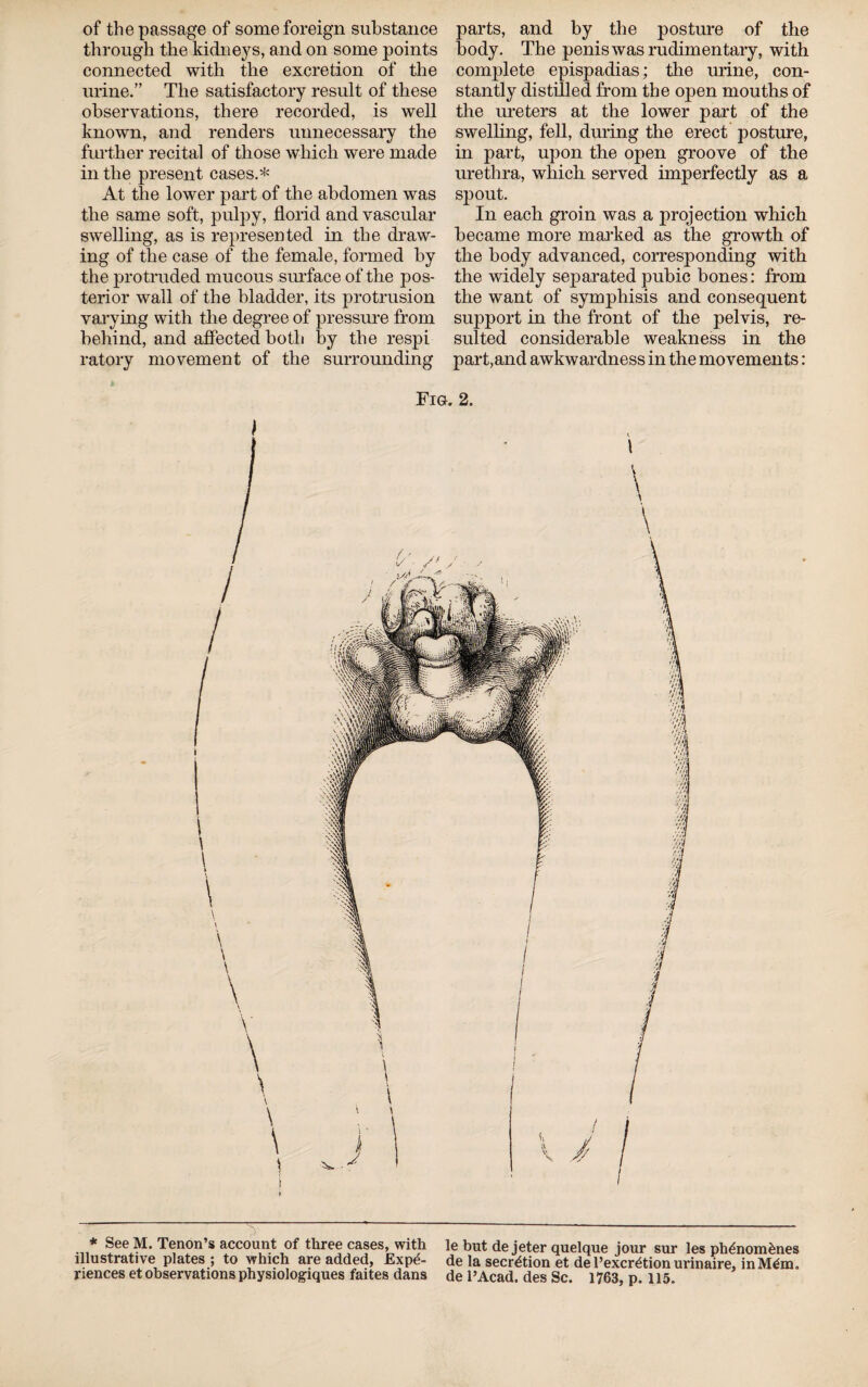 through the kidneys, and on some points connected with the excretion of the urine.” The satisfactory result of these observations, there recorded, is well known, and renders unnecessary the further recital of those which were made in the present cases.* At the lower part of the abdomen was the same soft, pulpy, florid and vascular swelling, as is represented in the draw¬ ing of the case of the female, formed by the protruded mucous surface of the pos¬ terior wall of the bladder, its protrusion varying with the degree of pressure from behind, and affected both by the respi ratory movement of the surrounding body. The penis was rudimentary, with complete epispadias; the urine, con¬ stantly distilled from the open mouths of the ureters at the lower part of the swelling, fell, during the erect posture, in part, upon the open groove of the urethra, which served imperfectly as a SJIOUt. In each groin was a projection which became more marked as the growth of the body advanced, corresponding with the widely separated pubic bones: from the want of symphisis and consequent support in the front of the pelvis, re¬ sulted considerable weakness in the part,and awkwardness in the movements : Fig, 2. * See M. Tenon’s account of three cases, with le but de jeter quelque jour sur les ph<*nom£nes illustrative plates; to which are added, £xp^- de la secretion et de l’excr^tion urinaire, in M^m. riences et observations physiologiques faites dans de l’Acad. des Sc. 1763, p. 115.