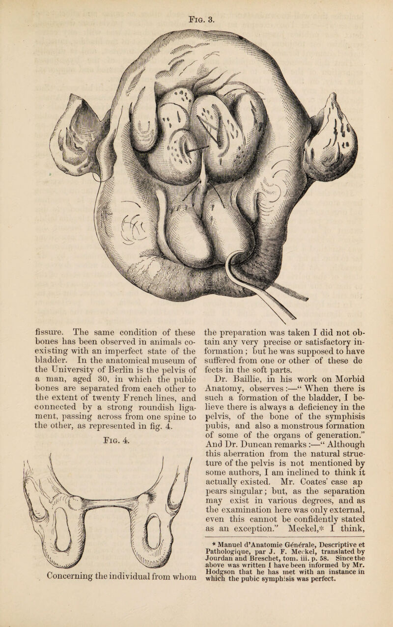 Fig. 3. the preparation was taken I did not ob¬ tain any very precise or satisfactory in¬ formation ; but lie was supposed to have suffered from one or other of these de fects in the soft parts. Dr. Baillie, in his work on Morbid Anatomy, observes :—“ When there is such a formation of the bladder, I be¬ lieve there is always a deficiency in the pelvis, of the bone of the symphisis pubis, and also a monstrous formation of some of the organs of generation.” And Dr. Duncan remarks :—“ Although this aberration from the natural struc¬ ture of the pelvis is not mentioned by some authors, I am inclined to think it actually existed. Mr. Coates’ case ap pears singular; but, as the separation may exist in various degrees, and as the examination here was only external, even this cannot be confidently stated as an exception.” Meckel,* I think, * Manuel d’Anatomie Generate, Descriptive et Pathologique, par J. F. Meckel, translated by Jourdan and Breschet, tom. iii. p. 58. Since the above w as written I have been informed by Mr. Hodgson that he has met with an instance in which the pubic symphisis was perfect. fissure. The same condition of these bones has been observed in animals co¬ existing with an imperfect state of the bladder. In the anatomical museum of the University of Berlin is the pelvis of a man, aged 30, in which the pubic bones are separated from each other to the extent of twenty French lines, and connected by a strong roundish liga¬ ment, passing across from one spine to the other, as represented in fig. 4. Fig. 4. Concerning the individual from whom