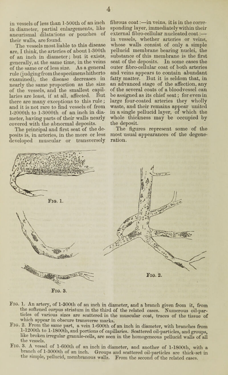 in vessels of less than l-500th of an inch fibrous coat:—in veins, it is in the corre- in diameter, partial enlargements, like sponding layer, immediately within their aneurismal dilatations or pouches of external fibro-cellular nucleated coat:— their walls, are found. in vessels, whether arteries or veins, The vessels most liable to this disease whose walls consist of only a simple are, I think, the arteries of about l-300tli pellucid membrane bearing nuclei, the of an inch in diameter; but it exists, substance of this membrane is the first generally, at the same time, in the veins seat of the deposits. In some cases the of the same or of less size. As a general outer fibro-cellular coat of both arteries rule (judging from the specimens hitherto and veins appears to contain abimdant examined), the disease decreases in fatty matter. But it is seldom that, in nearly the same proportion as the size an advanced stage of the affection, any of the vessels, and the smallest capil- of the several coats of a bloodvessel can laries are least, if at all, affected. But be assigned as its chief seat; for even in there are many exceptions to this rule ; large four-coated arteries they wholly and it is not rare to find vessels of from waste, and their remains appear united l-2000th to l-3000th of an inch in dia- in a single pellucid layer, of which the meter, having parts of their walls nearly whole thickness may be occupied by covered with the abnormal deposits. the deposit. The principal and first seat of the de- The figures represent some of the posits is, in arteries, in the more or less most usual appearances of the degene- developed muscular or transversely ration. Iig. 1. An artery, of l-300tli of an inch in diameter, and a branch given from it, from the softened corpus striatum in the third of the related cases. Numerous oil-par¬ ticles of various sizes are scattered in the muscular coat, traces of the tissue of which appear in obscure transverse marks. Fig. 2. From the same part, a vein l-600th of an inch in diameter, with branches from V1200th to l-1800th, and portions of capillaries. Scattered oil-particles, and groups, like broken irregular granule-cells, are seen in the homogeneous pellucid walls of all the vessels. Fig. 3. A vessel of l-600th of an inch in diameter, and another of l-1800th, with a branch of l-3000th of an inch. Groups and scattered oil-particles are thick-set in the simple, pellucid, membranous walls. From the second of the related cases.