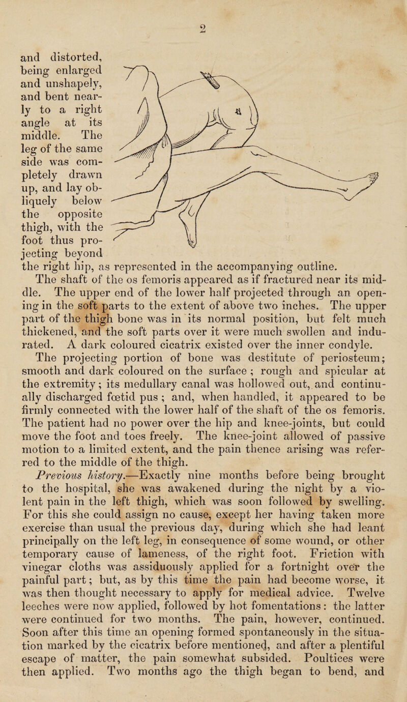 O and distorted, being enlarged and unshapely, and bent near¬ ly to a right angle at its middle. The leg of the same side was com¬ pletely drawn up, and lay ob¬ liquely below the opposite thigh, with the foot thus pro¬ jecting beyond the right hip, as represented in the accompanying outline. The shaft of the os femoris appeared as if fractured near its mid¬ dle. The upper end of the lower half projected through an open¬ ing in the soft parts to the extent of above two inches. The upper part of the thigh bone was in its normal position, but felt much thickened, and the soft parts over it were much swollen and indu¬ rated. A dark coloured cicatrix existed over the inner condyle. The projecting portion of bone was destitute of periosteum; smooth and dark coloured on the surface ; rough and spicular at the extremity; its medullary canal was hollowed out, and continu¬ ally discharged foetid, pus ; and, when handled, it appeared to be firmly connected with the lower half of the shaft of the os femoris. The patient had no power over the hip and knee-joints, but could move the foot and toes freely. The knee-joint allowed of passive motion to a limited extent, and the pain thence arising was refer¬ red to the middle of the thigh. Previous history.—Exactly nine months before being brought to the hospital, she was awakened during the night by a vio¬ lent pain in the left thigh, which was soon followed by swelling. For this she could assign no cause, except her having taken more exercise than usual the previous day, during which she had leant principally on the left leg, in consequence of some wound, or other temporary cause of lameness, of the right foot. Friction with vinegar cloths was assiduously applied for a fortnight over the painful part; but, as by this time the pain had become worse, it was then thought necessary to apply for medical advice. Twelve leeches were now applied, followed by hot fomentations: the latter were continued for two months. The pain, however, continued. Soon after this time an opening formed spontaneously in the situa¬ tion marked by the cicatrix before mentioned, and after a plentiful escape of matter, the pain somewhat subsided. Poultices were then applied. Two months ago the thigh began to bend, and