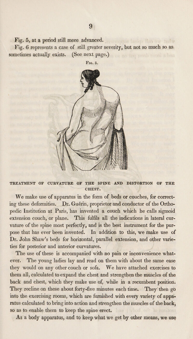 Fig. 5, at a period still more advanced. Fig. 6 represents a case of still greater severity, but not so much so as; sometimes actually exists. (See next page.) Fig. 5. TREATMENT OF CURVATURE OF THE SPINE AND DISTORTION OF THE CHEST. We make use of apparatus in the form of beds or couches, for correct¬ ing these deformities. Dr. Guerin, proprietor and conductor of the Ortho¬ pedic Institution at Paris, has invented a couch which he calls sigmoid extension couch, or plane. This fulfils all the indications in lateral cur¬ vature of the spine most perfectly, and is the best instrument for the pur¬ pose that has ever been invented. In addition to this, we make use of Dr. John Shaw’s beds for horizontal, parallel extension, and other varie¬ ties for posterior and anterior curvatures. The use of these is accompanied with no pain or inconvenience what¬ ever. The young ladies lay and read on them with about the same ease they would on any other couch or sofa. We have attached exercises to them all, calculated to expand the chest and strengthen the muscles of the back and chest, which they make use of, while in a recumbent position. They recline on these about forty-five minutes each time. They then go into the exercising rooms, which are furnished with every variety of appa¬ ratus calculated to bring into action and strengthen the muscles of the back, so as to enable them to keep the spine erect. As a body apparatus, and to keep what we get by other means, we use