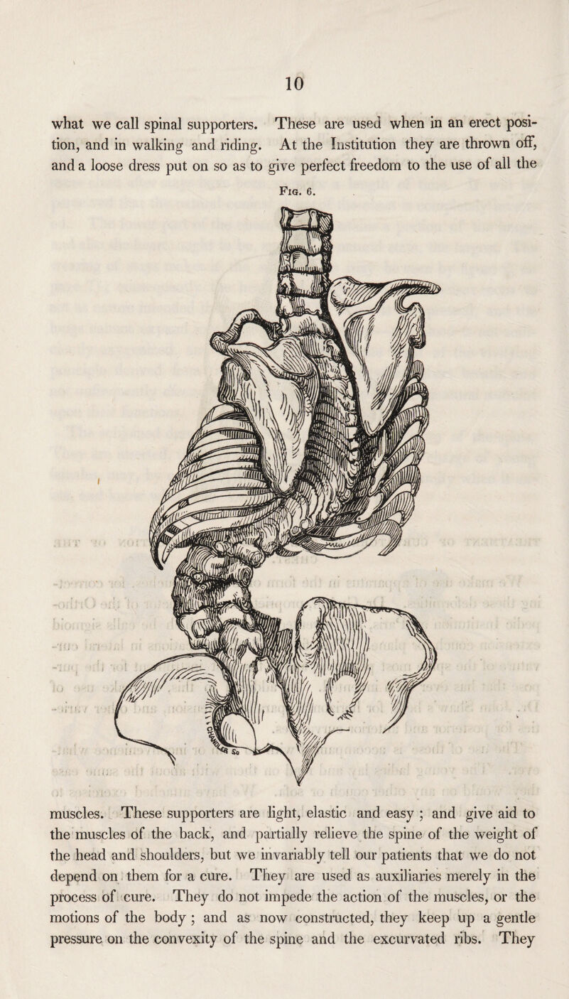 tion, and in walking and riding. At the Institution they are thrown off, and a loose dress put on so as to give perfect freedom to the use of all the Fig. 6. muscles. These supporters are light, elastic and easy ; and give aid to the muscles of the back, and partially relieve the spine of the weight of the head and shoulders, but we invariably tell our patients that we do not depend on them for a cure. They are used as auxiliaries merely in the process of cure. They do not impede the action of the muscles, or the motions of the body ; and as now constructed, they keep up a gentle pressure on the convexity of the spine and the excurvated ribs. They