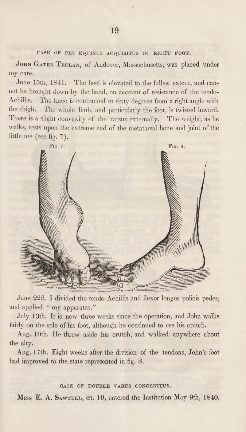 I 19 CASE OF PES EQUINUS ACQUISITUS OF RIGHT FOOT. John Gates Trulan, of Andover, Massachusetts, was placed under my care. June 15th, 1841. The heel is elevated to the fullest extent, and can¬ not be brought down by the hand, on account of resistance of the tendo- Achillis. The knee is contracted to sixty degrees from a right angle with the thigh. The whole limb, and particularly the foot, is twisted inward. There is a slight convexity of the tarsus externally. The weight, as he walks, rests upon the extreme end of the metatarsal bone and joint of the little toe (see fig. 7). Fig. 7. Fig. 8. June 22d. I divided the tendo-Achillis and flexor longus policis pedes, and applied cc my apparatus.” July 13th. It is now three weeks since the operation, and John walks fairly on the sole of his foot, although he continued to use his crutch. Aug. 10th. He threw aside his crutch, and walked anywhere about the city. Aug. 17th. Eight weeks after the division of the tendons, John’s foot had improved to the state represented in fig. 8. CASE OF DOUBLE VARUS CONGENITUS. Miss E. A. Sawtell, set. 10, entered the Institution May 9th, 1840,