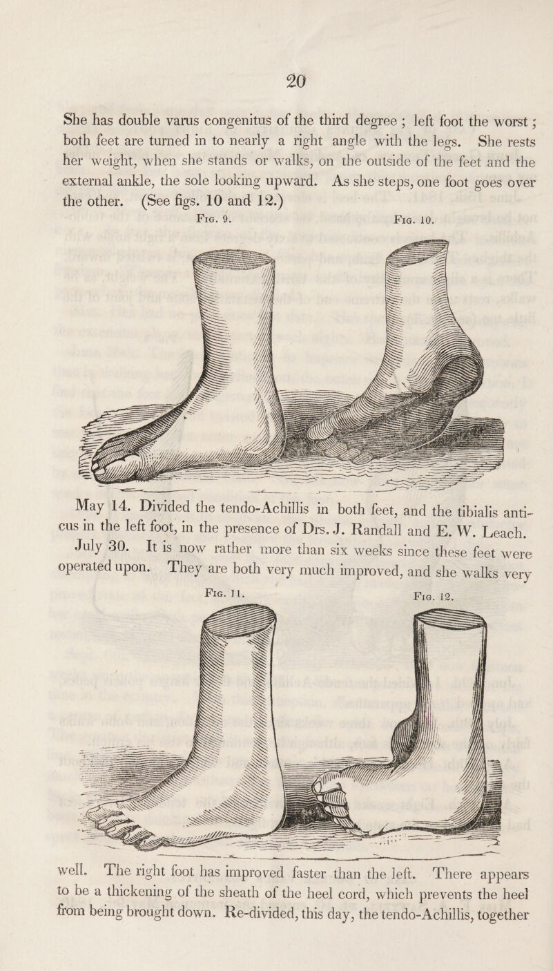 She has double varus congenitus of the third degree ; left foot the worst; both feet are turned in to nearly a right angle with the legs. She rests her weight, when she stands or walks, on the outside of the feet and the external ankle, the sole looking upward. As she steps, one foot goes over the other. (See figs. 10 and 12.) Fig. 9. Fig. 10. May 14. Divided the tendo-Achillis in both feet, and the tibialis anti- cus in the left foot, in the presence of Drs, J. Randall and E. W. Leach. July 30. It is now rather more than six weeks since these feet were operated upon. They are both very much improved, and she walks very Fig. 12. well. The right foot has improved faster than the left. There appears to be a thickening ol the sheath of the heel cord, which prevents the heel from being brought down. Re-divided, this day, the tendo-Achillis, together