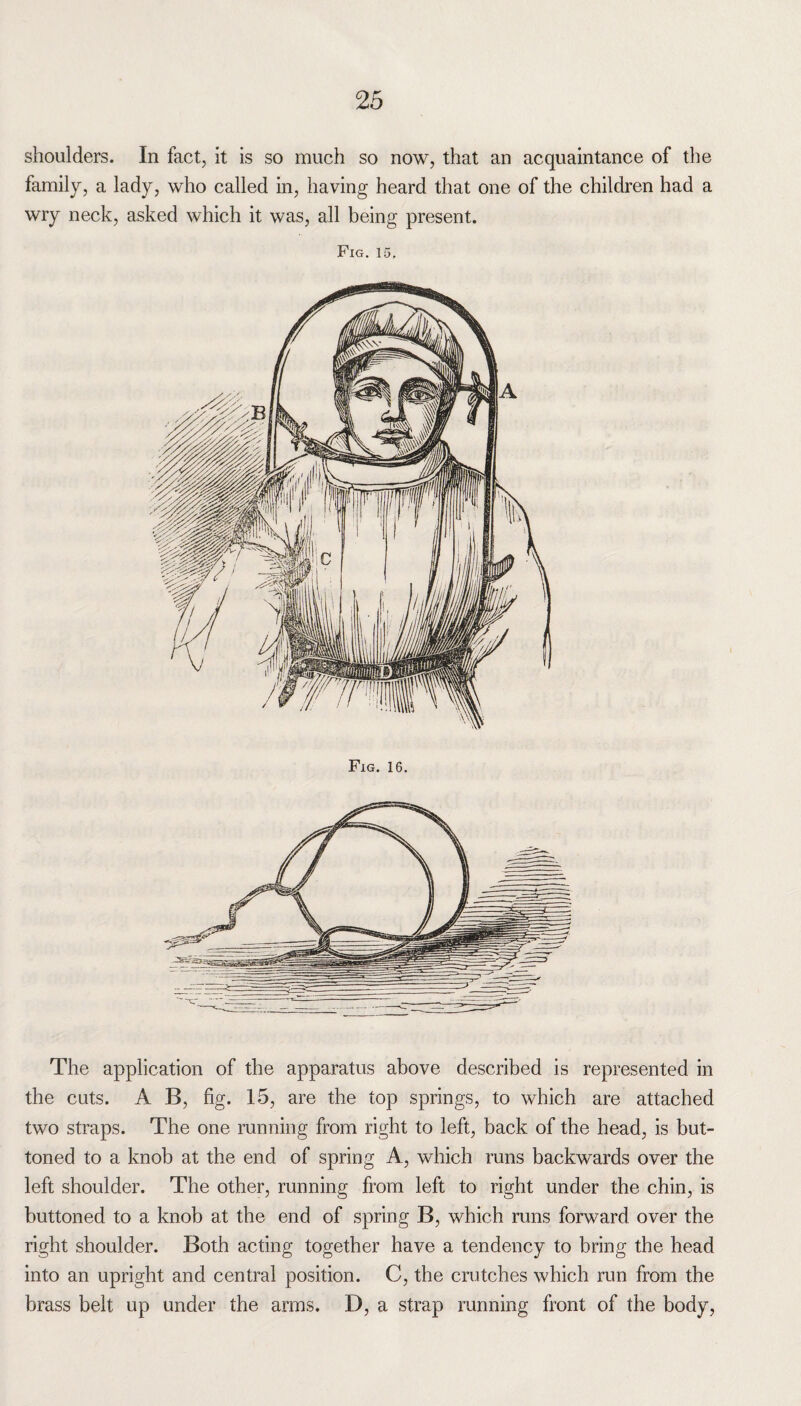 shoulders. In fact, it is so much so now, that an acquaintance of the family, a lady, who called in, having heard that one of the children had a wry neck, asked which it was, all being present. Fig. 15. The application of the apparatus above described is represented in the cuts. A B, fig. 15, are the top springs, to which are attached two straps. The one running from right to left, back of the head, is but¬ toned to a knob at the end of spring A, which runs backwards over the left shoulder. The other, running from left to right under the chin, is buttoned to a knob at the end of spring B, which runs forward over the right shoulder. Both acting together have a tendency to bring the head into an upright and central position. C, the crutches which run from the brass belt up under the arms. D, a strap running front of the body,