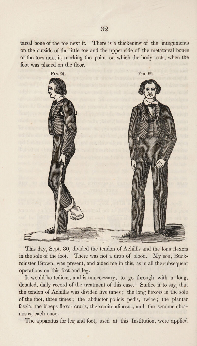 tarsal bone of the toe next it. There is a thickening of the integuments on the outside of the little toe and the upper side of the metatarsal bones of the toes next it, marking the point on which the body rests, when the foot was placed on the floor. Fig. 21. Fig. 22. This day, Sept. 30, divided the tendon of Achillis and the long flexors in the sole of the foot. There was not a drop of blood. My son, Buck¬ minster Brown, was present, and aided me in this, as in all the subsequent operations on this foot and leg. It would be tedious, and is unnecessary, to go through with a long, detailed, daily record of the treatment of this case. Suffice it to say, that the tendon of Achillis was divided five times ; the long flexors in the sole of the foot, three times ; the abductor policis pedis, twice ; the plantar fascia, the biceps flexor cruris, the semitendinosus, and the semimembra¬ nosus, each once. The apparatus for leg and foot, used at this Institution, were applied