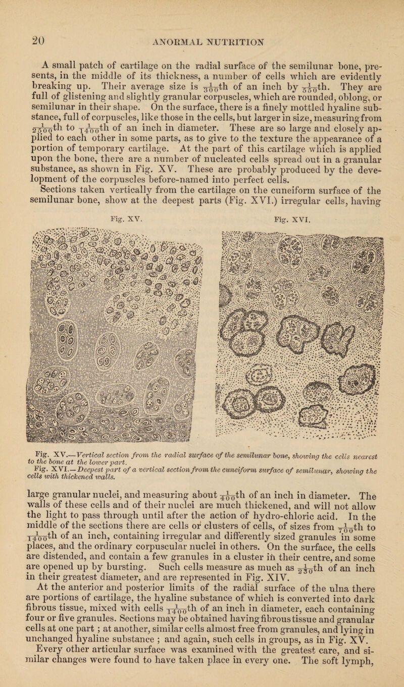 A small patch of cartilage on the radial surface of the semilunar hone, pre¬ sents, in the middle of its thickness, a number of cells which are evidently breaking up. Their average size is -g^th of an inch by g^th. They are full of glistening and slightly granular corpuscles, which are rounded, oblong, or semilunar in their shape. On the surface, there is a finely mottled hyaline sub¬ stance, full of corpuscles, like those in the cells, but larger in size, measuring from 2 50 0 th 1° T-^oth of an inch in diameter. These are so large and closely ap¬ plied to each other in some parts, as to give to the texture the appearance of a portion of temporary cartilage. At the part of this cartilage which is applied upon the bone, there are a number of nucleated cells spread out in a granular substance, as shown in Fig. XV. These are probably produced by the deve¬ lopment of the corpuscles before-named into perfect cells. Sections taken vertically from the cartilage on the cuneiform surface of the semilunar bone, show at the deepest parts (Fig. XYI.) irregular cells, having Fig. XV. Fig. XVI. Fig. XV—Vertical section from the radial surface of the semilunar hone, showing the cells nearest to the hone at the lower part. Fig. XVI.—Deepest part of a vertical section from the cuneiform surface of semilunar, showing the cells with thickened walls. large granular nuclei, and measuring about ^^th of an inch in diameter. The walls of these cells and of their nuclei are much thickened, and will not allow the light to pass through until after the action of hydro-chloric acid. In the middle of the sections there are cells of clusters of cells, of sizes from yi^th t° Trwoth of an inch, containing irregular and differently sized granules in some places, and the ordinary corpuscular nuclei in others. On the surface, the cells are distended, and contain a few granules in a cluster in their centre, and some are opened up by bursting. Such cells measure as much as 2x0th °f an inch in their greatest diameter, and are represented in Fig. XIY. At the anterior and posterior limits of the radial surface of the ulna there are portions of cartilage, the hyaline substance of which is converted into dark fibrous tissue, mixed with cells 14100th of an inch in diameter, each containing four or five granules. Sections may be obtained having fibrous tissue and granular cells at one part; at another, similar cells almost free from granules, and lying in unchanged hyaline substance ; and again, such cells in groups, as in Fig. XV. Every other articular surface was examined with the greatest care, and si¬ milar changes were found to have taken place in every one. The soft lymph,