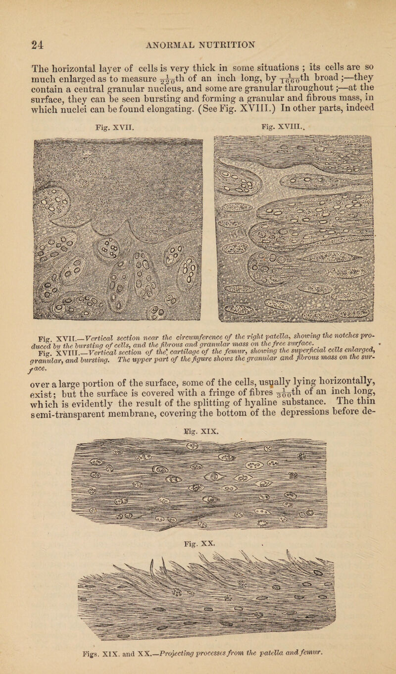 Tlie horizontal layer of cells is very thick in some situations ; its cells are so much enlarged as to measure an 1 <ui o^1 kroacl >—they contain a central granular nucleus, and some are granular throughout;—at the surface, they can be seen bursting and forming a granular and fibrous mass, in which nuclei can be found elongating, (See Fig. XVIII,) In other parts, indeed Fig. XVII. Fig. XVIII., Fig XVII_Vertical section near the circumference of the right patella, showing the notches pro¬ duced tv the burstinq of cells, and the fibrous and granular mass on the free surface. Fisr XVIII._Vertical section of the’ cartilage of the femur, showing the superficial cells enlarged, granular, and bursting. The upper part of the figure shows the granular and fibrous mass on the sur¬ face. over a large portion of the surface, some of the cells, usyally lying horizontally, exist; but the surface is covered with a fringe of fibres ^-^th of an inch long, which is evidently the result of the splitting of hyaline substance. The thin semi-transparent membrane, covering the bottom of the depressions before de~ Fig. XIX. Fig. XX. Figs. XIX. and XX.—Projecting processes from the patella and femur.