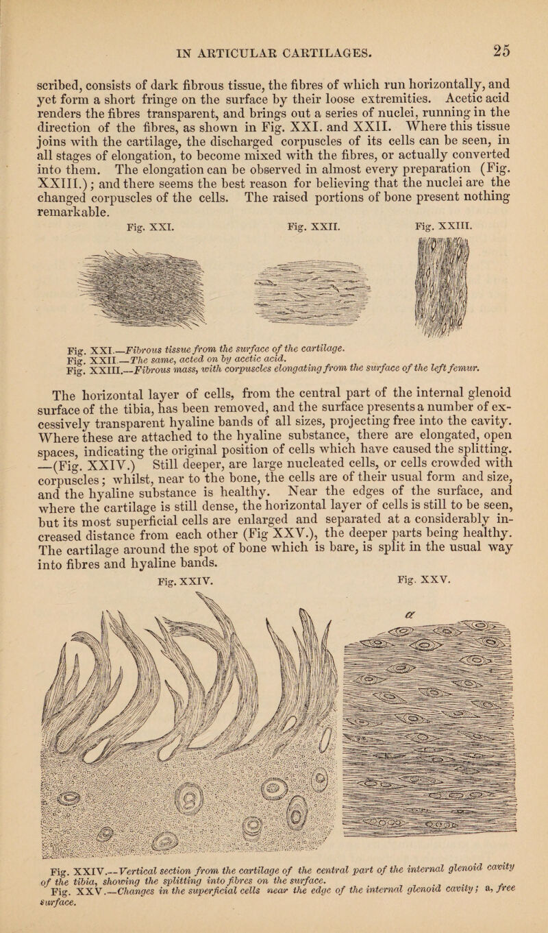 scribed, consists of dark fibrous tissue, the fibres of which run horizontally, and yet form a short fringe on the surface by their loose extremities. Acetic acid renders the fibres transparent, and brings out a series of nuclei, running in the direction of the fibres, as shown in Fig. XXI. and XXII. Where this tissue joins with the cartilage, the discharged corpuscles of its cells can be seen, in all stages of elongation, to become mixed with the fibres, or actually converted into them. The elongation can be observed in almost every preparation (Fig. XXIII.); and there seems the best reason for believing that the nuclei are the changed corpuscles of the cells. The raised portions of bone present nothing- remarkable. Fig. XXI. Fig. XXII. Fig. XXIII. Fig. XXI.—Fibrous tissue from the surface of the cartilage. Fig. XXII._The same, acted on by acetic acid. Fig. XXIII._Fibrous mass, with corpuscles elongating from the surface of the left femur. The horizontal layer of cells, from the central part of the internal glenoid surface of the tibia, has been removed, and the surface presents a number of ex¬ cessively transparent hyaline bands of all sizes, projecting free into the cavity. Where these are attached to the hyaline substance, there are elongated, open spaces, indicating the original position of cells which have caused the splitting. _(Fig. XXIV.) Still deeper, are large nucleated cells, or cells crowded with corpuscles; whilst, near to the bone, the cells are of their usual form and size, and the hyaline substance is healthy. Near the edges of the surface, and where the cartilage is still dense, the horizontal layer of cells is still to be seen, but its most superficial cells are enlarged and separated at a considerably in¬ creased distance from each other (Fig XXV.), the deeper parts being healthy. The cartilage around the spot of bone which is bare, is split in the usual way into fibres and hyaline bands. Fig. XXIV. Fig XXV. Fig. XXIV._Vertical section from the cartilage of the central part of the internal glenoid cam y of the tibia, showing the splitting into fibres on the surface. . . Fig. XXV.—Changes in the superficial cells near the edge of the internal glenoid cavity; a, free surface.