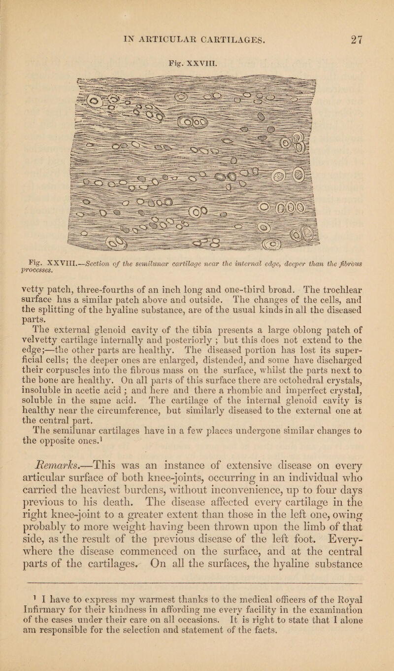 Fig. XXVIII. Fig. XXVIII. —Section of the semilunar cartilage near the internal edge, deeper than the fibrous processes. vetty patch, three-fourths of an inch long and one-third broad. The trochlear surface has a similar patch above and outside. The changes of the cells, and the splitting of the hyaline substance, are of the usual kinds in all the diseased parts. The external glenoid cavity of the tibia presents a large oblong patch of velvetty cartilage internally and posteriorly ; but this does not extend to the edge;—the other parts are healthy. The diseased portion has lost its super¬ ficial cells; the deeper ones are enlarged, distended, and some have discharged their corpuscles into the fibrous mass on the surface, whilst the parts next to the bone are healthy. On all parts of this surface there are octohedral crystals, insoluble in acetic acid ; and here and there a rhombic and imperfect crystal, soluble in the same acid. The cartilage of the internal glenoid cavity is healthy near the circumference, but similarly diseased to the external one at the central part. The semilunar cartilages have in a few places undergone similar changes to the opposite ones.1 Remarks.—This was an instance of extensive disease on every articular surface of both knee-joints, occurring in an individual who carried the heaviest burdens, without inconvenience, up to four days previous to his death. The disease affected every cartilage in the right knee-joint to a greater extent than those in the left one, owing probably to more weight having been thrown upon the limb of that side, as the result of the previous disease of the left foot. Every¬ where the disease commenced on the surface, and at the central parts of the cartilages^ On all the surfaces, the hyaline substance 1 I have to express my warmest thanks to the medical officers of the Royal Infirmary for their kindness in affording me every facility in the examination of the cases under their care on all occasions. It is right to state that I alone am responsible for the selection and statement of the facts.