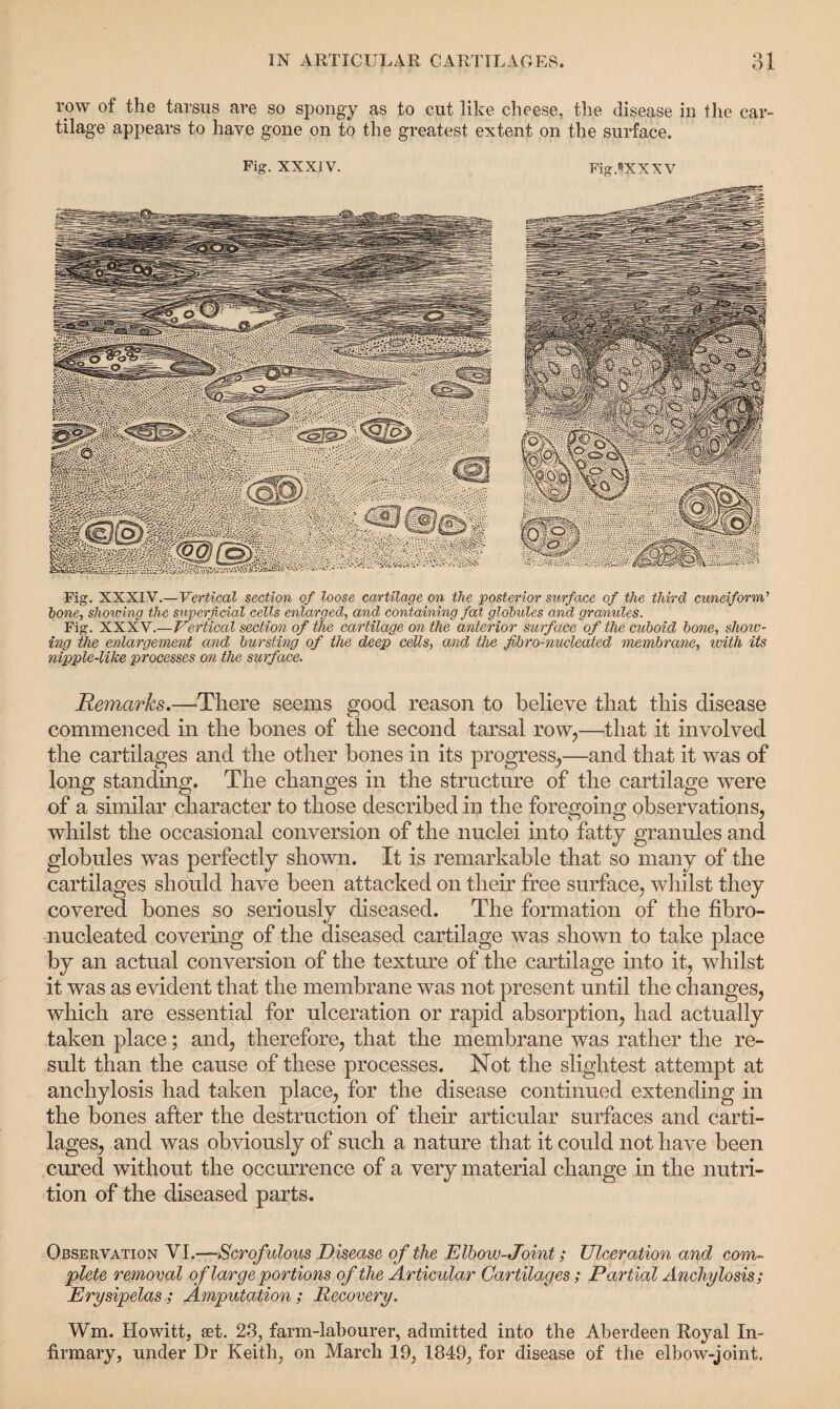 row of the tarsus are so spongy as to cut like cheese, the disease in the car¬ tilage appears to have gone on to the greatest extent on the surface. Fig. XXXIV. Fig.SXXXV Fig. XXXIV.—Vertical section of loose cartilage on the posterior surface of the third cuneiform’ hone, showing the superficial cells enlarged, and containing fat globules and granules. Fig. XXXV.—Vertical section of the cartilage on the anterior surface of the cuboid bone, show¬ ing the enlargement and bursting of the deep cells, and the jibro-nucleated membrane, with its nipple-like processes on the surface. Remarks.—There seems good reason to believe that this disease commenced in the bones of the second tarsal row,—that it involved the cartilages and the other bones in its progress,—and that it was of long standing. The changes in the structure of the cartilage were of a similar character to those described in the foregoing observations, whilst the occasional conversion of the nuclei into fatty granules and globules was perfectly shown. It is remarkable that so many of the cartilages should have been attacked on their free surface, whilst they covered bones so seriously diseased. The formation of the fibro- nucleated covering of the diseased cartilage was shown to take place by an actual conversion of the texture of the cartilage into it, whilst it was as evident that the membrane was not present until the changes, which are essential for ulceration or rapid absorption, had actually taken place; and, therefore, that the membrane was rather the re¬ sult than the cause of these processes. Not the slightest attempt at anchylosis had taken place, for the disease continued extending in the bones after the destruction of their articular surfaces and carti¬ lages, and was obviously of such a nature that it could not have been cured without the occurrence of a very material change in the nutri¬ tion of the diseased parts. Observation VI.—Scrofulous Disease of the Elbow-Joint; Ulceration and com¬ plete removal of large portions of the Articular Cartilages; Partial Anchylosis; Erysipelas; Amputation; Recovery. Wm. Howitt, set. 23, farm-labourer, admitted into the Aberdeen Royal In¬ firmary, under Dr Keith, on March 19, 1849, for disease of the elbow-joint,