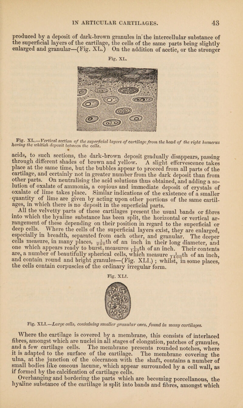 produced by a deposit of dark-brown granules in the intercellular substance of the superficial layers of the cartilage, the cells of the same parts being slightly enlarged and granular-—(Fig. XL.) On the addition of acetic, or the stronger Fig. XL. Fig. XL.—Vertical section of the superficial layers of cartilage from the head of the right humerus having the whitish deposit between the cells. acids, to such sections, the dark-brown deposit gradually disappears, passing through different shades of brown and yellow. A slight effervescence takes place at the same time, but the bubbles appear to proceed from all parts of the cartilage, and certainly not in greater number from the dark deposit than from other parts. On neutralising the acid solutions thus obtained, and adding a so¬ lution of oxalate of ammonia, a copious and immediate deposit of crystals of oxalate of lime takes place. Similar indications of the existence of a smaller quantity of lime are. given by acting upon other portions of the same cartil¬ ages, in which there is no deposit in the superficial parts. All the velvetty parts of these cartilages present the usual bands or fibres into which the hyaline substance has been split, the horizontal or vertical ar¬ rangement of these depending on their position in regard to the superficial or deep cells.. Where the cells of the superficial layers exist, they are enlarged, especially in breadth, separated from each other, and granular. The deeper cells measure, in many places, 2(h)th. an inch in their long diameter, and one which appears ready to burst, measures y^th of an inch. Their contents are, a number of beautifully spherical cells, which measure y^th of an inch, and contain round and bright granules—(Fig. XLI.) ; whilst, in some places, the cells contain corpuscles of the ordinary irregular form. Fig. XLI. Fig. XLI.—Large cells, containing smaller granular ones, found in many cartilages. Where the cartilage is covered by a membrane, this consists of interlaced fibres, amongst which are nuclei in all stages of elongation, patches of granules, and a few cartilage cells. The membrane presents rounded notches, where it is adapted to the surface of the cartilage. The membrane covering the ulna, at the junction of the olecranon with the shaft, contains a number of small bodies like osseous lacunae, which appear surrounded by a cell wall, as if formed by the calcification of cartilage cells. Overhanging and bordering the parts which are becoming porcellanous, the hyaline substance of the cartilage is split into bands and fibres, amongst which