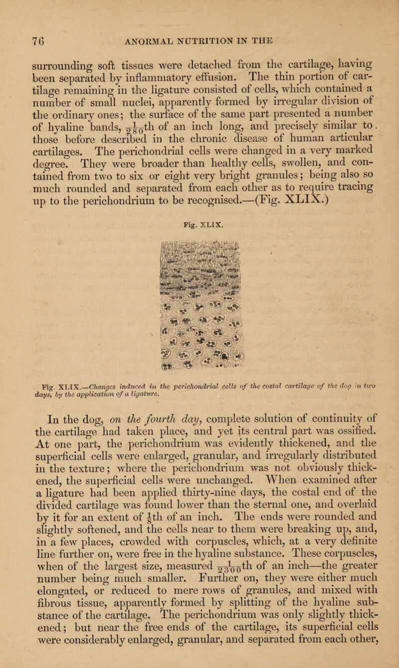 surrounding soft tissues were detached from the cartilage, having been separated by inflammatory effusion. The thin portion of car¬ tilage remaining in the ligature consisted of cells, which contained a number of small nuclei, apparently formed by irregular division of the ordinary ones; the surface of the same part presented a number of hyaline bands, ^J^th of an inch long, and precisely similar to. those before described in the chronic disease of human articular cartilages. The perichondrial cells were changed in a very marked degree. They were broader than healthy cells, swollen, and con¬ tained from two to six or eight very bright granules; being also so much rounded and separated from each other as to require tracing up to the perichondrium to be recognised.—(Fig. XLIX.) Fig. XLIX. Fig. XLIX.—Changes induced in the 'perichondrial cells of the costal cartilage of the dog in two days, by the application of a ligature. In the dog, on the fourth day, complete solution of continuity of the cartilage had taken place, and yet its central part was ossified. At one part, the perichondrium was evidently thickened, and the superficial cells were enlarged, granular, and irregularly distributed in the texture; where the perichondrium was not obviously thick¬ ened, the superficial cells were unchanged. When examined after a ligature had been applied thirty-nine days, the costal end of the divided cartilage was found lower than the sternal one, and overlaid by it for an extent of Jth of an inch. The ends were rounded and slightly softened, and the cells near to them were breaking up, and, in a few places, crowded with corpuscles, which, at a very definite line further on, were free in the hyaline substance. These corpuscles, when of the largest size, measured 23*0 0^ an *nch—the grea^er number being much smaller. Further on, they were either much elongated, or reduced to mere rows of granules, and mixed with fibrous tissue, apparently formed by splitting of the hyaline sub¬ stance of the cartilage. The perichondrium was only slightly thick¬ ened ; but near the free ends of the cartilage, its superficial cells were considerably enlarged, granular, and separated from each other,