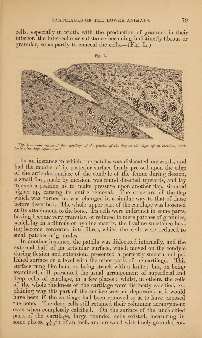 cells, especially in width, with the production of granules in their interior, the inter-cellular substance becoming indistinctly fibrous or granular, so as partly to conceal the cells.—(Fig. L.) Fig. L. In an instance in which the patella was dislocated outwards, and had the middle of its posterior surface firmly pressed upon the edge of the articular surface of the condyle of the femur during flexion, a small flap, made by incision, was found directed upwards, and lay m such a position as to make pressure upon another flap, situated higher up, causing its entire removal. The structure of the flap which was turned up was changed in a similar way to that of those before described. The whole upper part of the cartilage was loosened at its attachment to the bone. Its cells were indistinct in some parts, having become very granular, or reduced to mere patches of granules, which lay in a fibrous or hyaline matrix, the hyaline substance hav¬ ing become converted into fibres, whilst the cells were reduced to small patches of granules. In another instance, the patella was dislocated internally, and the external half of its articular surface, which moved on the condyle during flexion and extension, presented a perfectly smooth and po¬ lished surface on a level with the other parts of the cartilage. This surface rung like bone on being struck with a knife; but, on being examined, still presented the usual arrangement of superficial and deep cells of cartilage, in a few places; whilst, in others, the cells of the whole thickness of the cartilage were distinctly calcified, ex¬ plaining why this part of the surface was not depressed, as it would have been if the cartilage had been removed so as to have exposed the bone. The deep cells still retained their columnar arrangement even when completely calcified. On the surface of the uncalcified parts of the cartilage, large rounded cells existed, measuring in some places, ^ gth of an inch, and crowded with finely granular cor-