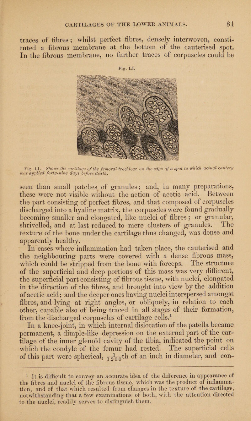 traces of fibres; whilst perfect fibres, densely interwoven, consti¬ tuted a fibrous membrane at the bottom of the cauterised spot. In the fibrous membrane, no further traces of corpuscles could be Fig. LI. Fig. LI.—Shows the cartilage of the femoral trochlear on the edge of a spot to which actual cautery was applied forty-nine days before death. seen than small patches of granules; and, in many preparations, these were not visible without the action of acetic acid. Between the part consisting of perfect fibres, and that composed of corpuscles discharged into a hyaline matrix, the corpuscles were found gradually becoming smaller and elongated, like nuclei of fibres ; or granular, shrivelled, and at last reduced to mere clusters of granules. The texture of the bone under the cartilage thus changed, was dense and apparently healthy. In cases where inflammation had taken place, the cauterised and the neighbouring parts were covered with a dense fibrous mass, which could be stripped from the bone with forceps. The structure of the superficial and deep portions of this mass was very different, the superficial part consisting of fibrous tissue, with nuclei, elongated in the direction of the fibres, and brought into view by the addition of acetic acid; and the deeper ones having nuclei interspersed amongst fibres, and lying at right angles, or obliquely, in relation to each other, capable also of being traced in all stages of their formation, from the discharged corpuscles of cartilage cells.1 In a knee-joint, in which internal dislocation of the patella became permanent, a dimple-like depression on the external part of the car¬ tilage of the inner glenoid cavity of the tibia, indicated the point on which the condyle of the femur had rested. The superficial cells of this part were spherical, of an inch in diameter, and con- 1 It is difficult to convey an accurate idea of the difference in appearance of the fibres and nuclei of the fibrous tissue, which was the product of inflamma¬ tion, and of that which resulted from changes in the texture of the cartilage, notwithstanding that a few examinations of both, with the attention directed to the nuclei, readily serves to distinguish them.