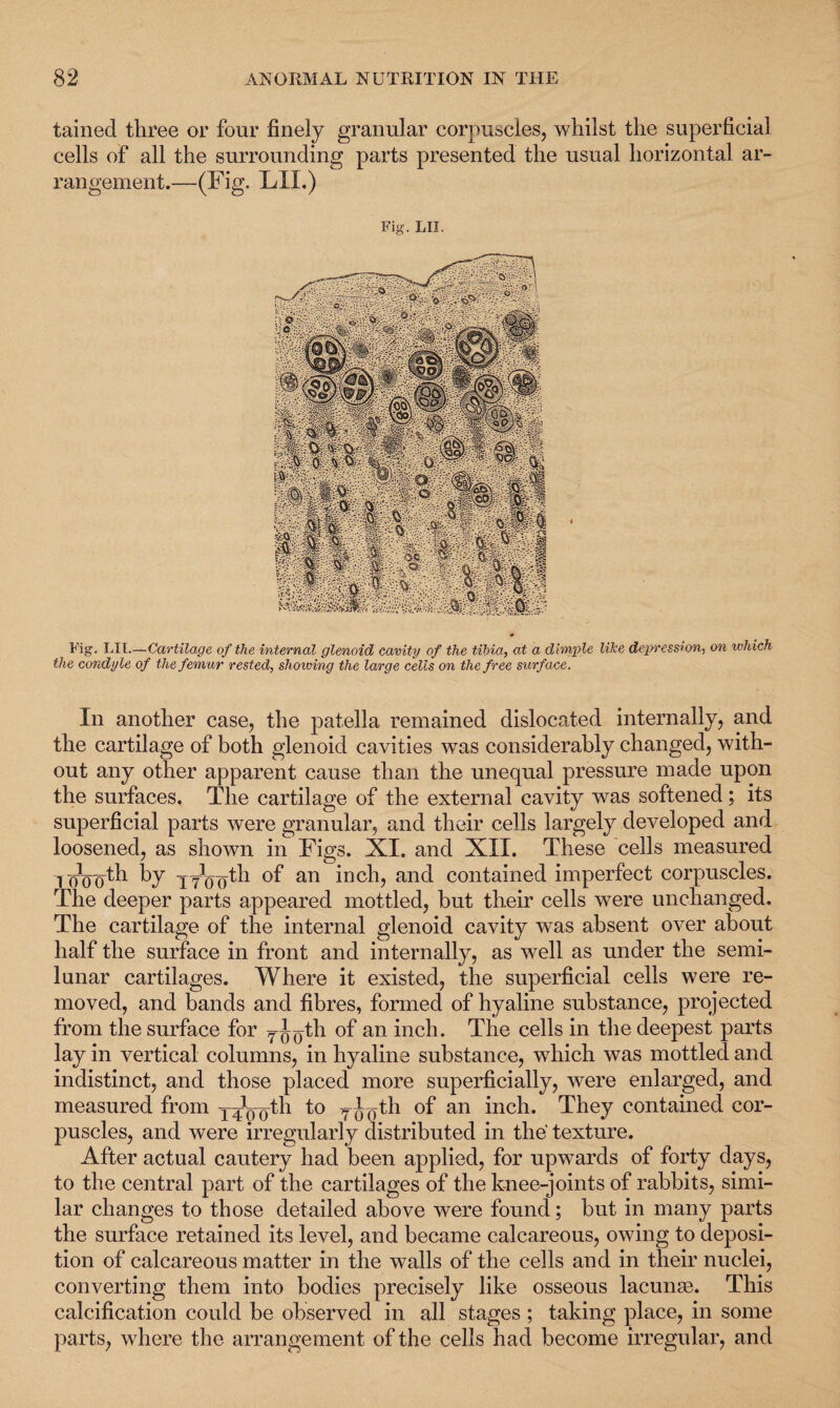 tained three or four finely granular corpuscles, whilst the superficial cells of all the surrounding parts presented the usual horizontal ar¬ rangement.—(Fig. LII.) Fig. LII. Fig. LII.—Cartilage of the internal glenoid cavity of the tibia, at a dimple like depression, on which the condyle of the femur rested, shoiving the large cells on the free surface. In another case, the patella remained dislocated internally, and the cartilage of both glenoid cavities was considerably changed, with¬ out any other apparent cause than the unequal pressure made upon the surfaces. The cartilage of the external cavity was softened; its superficial parts were granular, and their cells largely developed and loosened, as shown in Figs. XI. and XII. These cells measured l oVoth by yyoolF °f an inch, and contained imperfect corpuscles. The deeper parts appeared mottled, but their cells were unchanged. The cartilage of the internal glenoid cavity was absent over about half the surface in front and internally, as well as under the semi¬ lunar cartilages. Where it existed, the superficial cells were re¬ moved, and bands and fibres, formed of hyaline substance, projected from the surface for yj^th of an inch. The cells in the deepest parts lay in vertical columns, in hyaline substance, which was mottled and indistinct, and those placed more superficially, were enlarged, and measured from yy^yth to T^(Tth of an inch. They contained cor¬ puscles, and were irregularly distributed in the' texture. After actual cautery had been applied, for upwards of forty days, to the central part of the cartilages of the knee-joints of rabbits, simi¬ lar changes to those detailed above were found; but in many parts the surface retained its level, and became calcareous, owing to deposi¬ tion of calcareous matter in the walls of the cells and in their nuclei, converting them into bodies precisely like osseous lacunae. This calcification could be observed in all stages ; taking place, in some parts, where the arrangement of the cells had become irregular, and