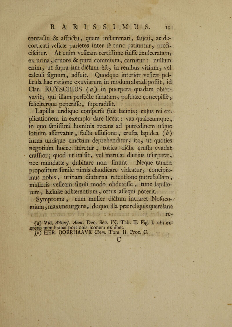 conta&u & affri&u, quem inflammati , faucii, ac de¬ corticati veficse parietes inter fe tunc patiuntur, proh- cifcitur. At enim veflcam certifiime fuifle exulceratam, ex urina, cruore & pure commixta, cernitur : nullum enim, ut fupra jam didtiim eft, in renibus vitium, vel calculi fignum, adfuit. Quodque interior veficae pel¬ licula hac ratione exuviarum in modum abradi poflit, id Clar. RUYSCI1IUS (<?) in puerpera quadam obfer- vavit, qui illam perfede fanatam, pofthsec concepiffe, feliciterque peperifle, fuperaddit. Lapillis undique confperfa fuit lacinia; cujus rei ex^ plicationem in exemplo dare liceat: vas qualecumque, in quo faniiTimi hominis recens ad putredinem ufque lotium affervatur, fadta effiifione , crufta lapidea (b) intus undique cinctum deprehenditur, ita, ut quoties negotium hocce iteretur , toties di&a crufta evadat crafllor; quod ut ita fit, vel matulae diutius ufiirpatae, nec mundatae, dubitare non finunt. Neque tamen, propofitum fimile nimis claudicare videatur, concipia¬ mus nobis , urinam diuturna retentione putrefactam , mulieris veficam fimili modo obduxifie , tunc lapillo¬ rum , laciniae adhaerentium, ortus afiequi poterit. Symptoma, cum mulier dictum intraret Nofbco-/ mium, maxime urgens., de quo illa prae reliquis querelans re- (a) Vid. AdverJ. Anat. Dec. Sec. IX. Tab. II. Fig. I. ubi ex~ firecqe membransejportionis iconem exhibet. ' XQ HER. BOERHAAVE Chsm. Tom. II. Proc. C. c