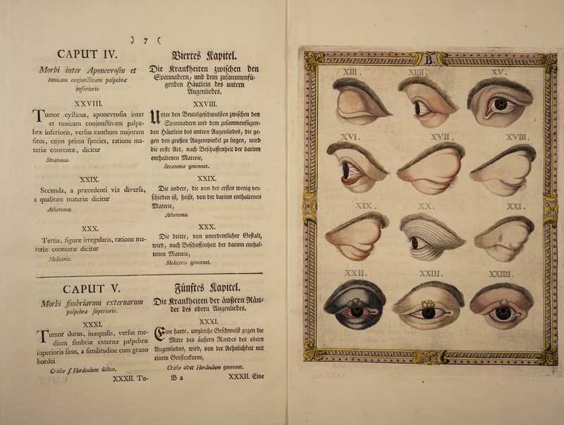 Morbi inter Aponevrofin et timkam conjuncfivam palpebr<e inferioris. XXVIII. rJ^umor cyfiicus, aponevrofin inter et tunicam conjunfrivam palpe- brx inferioris, verfus canthum majorem iitus, cujus prima fpecies, ratione ma¬ teria contents, dicitur Steatoma. V > XXIX. Secunda, a praccedenti vix diverfa, a qualitate materix dicitur Atheroma. XXX. Tertia, figure irregularis, ratione ma- terix contents dicitur Melkeris. CAPUT V. Morbi fimbriarnm externarum palpebrte Juperioris. XXXI. r-rumor durus, insequalis, verfus me- dium fimbria: externa: palpebr* fuperioris fitus, a fimilitudine cum grano hordei » . Critbe f Hordeolum diftus. XXXII. Tu- £ne ^vanfpeiten §mifd)cn Den ©pannakrit/ uni) bent sufaminenfu- genben JMutlein beg uittem Slugenliebeg. XXVIII. tttcr Pen 23eute(gefd)tou[|len jmifdgcit bett ©patmcibern unb bem jufammenfugett* ben #dutlein bed untent Siugeititebeg, bte ge= gen ben grolten Slugemomfel ju (tegen, roteb bie erfte Slrt, nad; 23efd)afenfjeit bee bartrat entf)altencn iOIatene, Steatoma genennef. XXIX. ©te mtbere, bie bott ber cifitett tbentgber-- fd)iebeit tfr, fjeijjt, bon ber batimt eittfjaiteiten SOlctferte, Atheroma. XXX. ®ie britte, bon unorbentltdjer ©ejlalt, tbirb, nad) 23cfd)affcn^eit bee batitm entf>i(= tenen SUateeie, Melkeris senennet. gunfte^ fapitel $tanf l>eitcn t»ev aupem bee beg obem Slugettitcbeg. XXXI. ine I)acte, ungieidje ©cfd)tbuf|I gegen bte 5)}ttte beg dufseett Sntttbeg beg obern Slugenltebeg, tbirb, bolt bee ?lef)n(id)fett mtt etnem ©erflenforne, Crithe obee Hordeolum genennef. 33 a XXXII. Sine