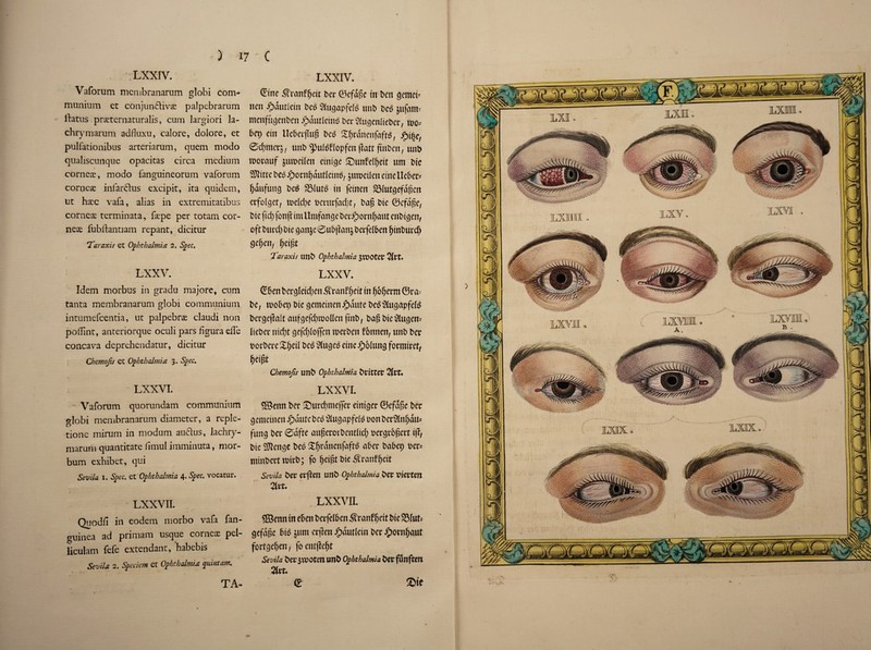 ; LXXIV. Vaforum mcmbranarum globi com-* muiiium et conjun&ivse palpebrarum flatus praeternaturalis, cum largiori la- chrymarum adfluxu, calore, dolore, et pulfationibus arteriarum, quern modo qualiscunque opacitas circa medium corneas, modo languineorum vaforum corueae infar&us excipit, ita quidem, ut haec vafa, alias in extremitatibus corneae terminata, faepe per totam cor¬ neas fubftantiam repant, dicitur Taraxis et Ophthalmia 2. Spec* L XXV. Idem morbus in gradu majore, cum tanta membranarum globi communium intumefcentia, ut palpebrae claudi non poflint, antenorque oculi pars figura effe concava deprehendatur, dicitur Ckemojis et Ophthalmia 3. Spec. LXXVI. Vaforum quorundam communium globi membranarum diameter, a reple- tione mirum in modum audlus, lachry- marum quantitate fimul imminuta, mor- bum exhibet, qui Sevila 1. Spec, et Ophthalmia 4.Spec, vocatur. LXXVII. Quodfi in eodem morbo vafa fan- guinea ad primam usque corner pel- liculam fele extendant, habebis Sevila 2. Speciem et Ophthalmia quint am. TA- LXXIV. ®tne .Sfranffjeit ter ©efdpe in t>ctt gemef tten ^)autletn te$ SHucjapfelo unt te£ jufant' menfusenten ipdutlein£ t>er ^(uQcnltetJcr, mo* 5cp ein tteterflup bc6 S^rdnenfafts, jpi§er 0d)merj, unO^u^flopfenjlattfi'itOerq unt rnovauf jumeilen etntge ©unfelpeit um tie SJIttte te£ £ornpdutleinS, juroctlctt etne Ueter* fjdufuncj teS 35lut3 in fetnen Slutcjefdpen crfolget, melcfye terurfad)t, tap tie ©efape, OtefidjfonjlimUmfan^eOa’^orn^autenOt^en, oft t>urd) t)te ganje 0utpan& terfelten fjinturcf) deceit, peipt ‘Taraxis Uttt Ophthahnia $T00tCt 2Itt. LXXV. ® ten ter$leid)en ranf peit in poperm @ra= te, mobep Die ejemetnen Jpdute teS'&ucjapfe^ tergejlalt aufgefcpmollen ftnt, tap tie^ugens licter ntept (jefcplojfen merten fonnen, unt ter tortere Sped te$ 2lucje£ eine iptlung formiret, peipt Chemojis unt Ophthalmia britter 2IrC. LXXVI. ® enn ter ©urdmtejfer etni^er ©efdpe ter ejemeinen jpauteteo ^ucjapfeh? ton ter^lnpdus fung ter 0dfte auperotbendtd) oercjrbpert i|T, tie ®enge tee Sprdnenfaft£ ater tatep ter* mtntertmirt; fo peipt tie .Sranfpeit Sevila ter erften mb ophthalmia ter vievten 2Ut. LXXVII. ©emt in eten terfelten 3?ranf peit tie Sluts gefdpe tio jum erpen Jjpdutlein ter #ornpaut fortejepen, focntjlept Sevila ter 3wotcn unt Ophthalmia ter funften 2ltt. e 2>te *