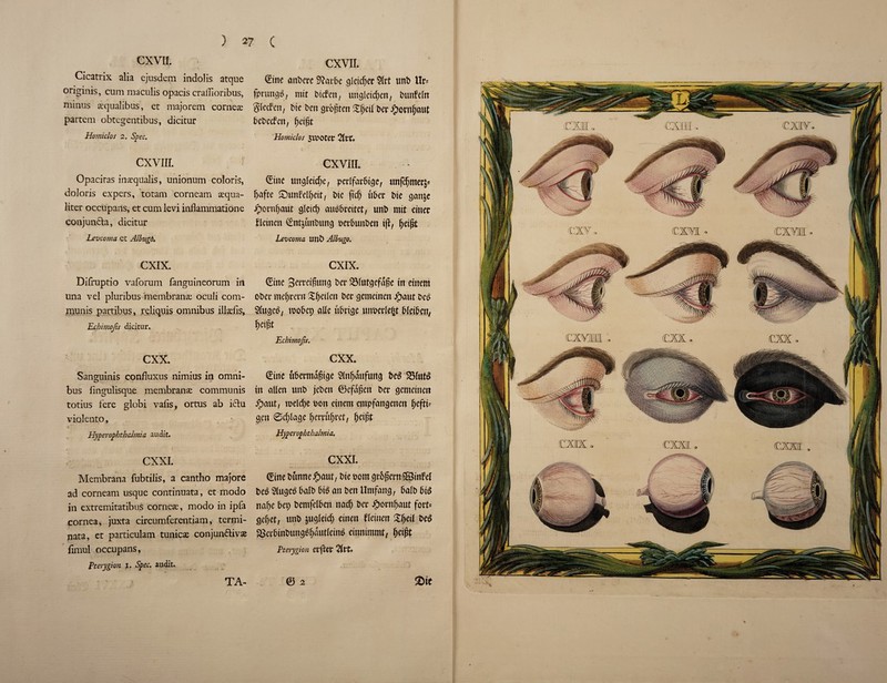 CXVII. Cicatrix alia ejusdem indolis atque originis, cum maculis opacis craflioribus, minus squalibus, et majorem corneas partem obtegentibus, dicitur Homiclos 2. Spec. cxviii. r Opaciras inaequalis, unionum coloris, doloris expers, totam corneam aequa- liter occupans, et cum levi inflammatione conjun£ta, dicitur Levcoma et Albugo. CXIX. Difruptio vafonim fanguineorum in una vel pluribus membranae oculi com¬ munis partibus, reliquis omnibus illaefis, Pihimofis dicitur. cxx. Sanguinis confluxus nimius in omni¬ bus iingulisque membrane communis totius fere globi vaiis, ortus ab iclu violento. Hyperophthalmia audit. CXXI. Membrana fubtilis, a cantho majore ad corneam usque continuata, et modo in extremitatibus cornese, modo in ipfa cornea, juxta circumferentiam, termi- nata, et particulam tunicae conjun&ivse limul occupans, Pterygion l. Spec, audit. TA- CXVII. ©ne anbere fftar&e gletdjer 5(rt unb Ur= fprungs, mit bidden, intgicxd^en, bunfeln 5‘Itcfen, t>te t)en grojnen Sljeil ber #orn()uut bet>ccfen, fjet£t Homiclos $\VOttV 011 CXVIIL ©ite ungletdje/ perlfar&tge, unfcfimerj* fjafte ©unfelfjetf, bte ftcf) fiber bie ganje £ornl)aut gfeicfo au^reitet, mb mit cmer fieinen (£nt&unbung uerbunben iff, ^eigt Levcoma Utli) Albugo. CXIX. Cine gerreifjung tier SMutgcfape in etnem ober mefjrertt Sijeiien ber gemeinen Jpaut Deb 2Iugcb, roobep alle ubrige un»erie|t bieiben, bei^t Echimojtr. CXX. ©rie ubermafnge Slnfjaufu&g be£ 251nt$ in alien unb jebett 0efa£en ber gemetnen Qaut, roeld)e bon etnem empfangenen ^eftt- gen 0d;lage fjemtfjret, ^etpt Hyperophthalmia. CXXI. <£ine bimne #aut, bie born grbfcrn SSinfel beb Slugcb balb bib an ben Umfang, baib bib nafje bep bemfelbett nacf) ber £ornf)aut fort* gef)et, unb jugleid) einen fieinen Zfycd beb aSerbtnbungbfjautieinb einnimmf, ^eipt Pterygion Cl'ftee ?ltt. @ 2 Site