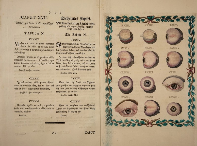 CAPUT XVII. faptfer. Morbi part mm iridis pupittm S)ic.^vanH)eitcnbef5:.()et(et)e6^ , formantium. flenbogenfovmtflen ftrcifcg, mldje ten ©tent bitten. TABULA N. JDic Zmte N. cxxxiv. \,Torborum haud exiguus numerus fedem in iride et cornea iimul figit, et oritur a diverfis fupra defcriptis abfcedibus. Quorum primus ea eft partium iridis, pupilJam formantium, dedruciio, qua hujus diameter minuitur, figura defor- matur. Hie morbus Synefefis i. Spec, vocatur. CXXXIV. OK>tr ftnbcrt t>erfc^tet)ene ^canfgetfett, tie tfjtett 0t§ bmkid) imSlegenftogen unt> tec #ornfjaut fjaften, unt ton ten often fte= fd;cieftenen ©efcfjttucen ent|le(jen. 3n etnec tiefer 5?can£(jettcn mecbett tie £(>et(e te£ ^enftogenS, tteldje ten 0tecn ftilDcrr f tecqeffrdt tecantecf, tafi tec £Ducd;- mejfec te£ 0tecnft f (etnec, unt feme ©ejia(t tectocften tttct, £)tefe ^ranfgett (jetgt Synefefis ecftCU 2ivt* cxxxv, Quodfi eoedem iridis partes dilace- ratae et confufae iint, ita ut duo vel tria in iride obferventur foramina, Synefejls 2. Spec, nuncupatur. cxxxv. SBemt eftcn ttefe XgeKe te$ Stetjenfto* cjeno jecctffen unt teccjefMt tecfdjoften frnt, tag man &mo ftt$ tcep Oejfnuncjen tacinn itaftcnimmt; fo entjlegt Synefefis 3COOCet* CXXXVI. Plenaria pupillsc occluiio, a partibus iridis earn conftituentibus dilaceratis ct confufls, dicitur Dtarexis. CXXXVI. 3Bemt tie jecctfifenen unt tecfdjofteiten £f)ci(e te6 Sve^eufto^en^ ten 0tecn b&tfttj tecfddtegen; fo entjtcgt tie Diarexis. $) 2