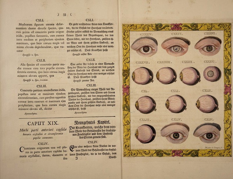 CXLI. Morborum figuram cornex defor- mantium dantur diverge fpecies, qua- rum prima ed concretio partis exigux iridis, pupillam formantis, cum cornea intra medium et peripheriam ejusdem maximam, quo loco cornea magis vel minus elevata deprehenditur, quae vo- catur Synapfife i. Spec. CXLII. Alia fpecies ed concretio partis me¬ diae corneae cum tota pupillx circum- ferentia externa, quo loco cornea magis minus ve elevata apparet, qux Synapfife 2. Spec, vocatur. CXLIII. Concretio partium nonnullarum iridis, pupillam inter et maximam ejusdem circumferentiam, cum partibus oppofitis cornex intra centrum et maximam ejus peripheriam, quo loco cornea magis minusve elevata ed, dicitur 1 Aponeuchyma. CXLI. (Ed gicbt bcrfdjtebettc Sieten eon S'ranf(jci= ten, biebie ©effaltbeeJpoenfjautoeeanbeen. jpieeffee gefjbet erfflid) bie SBeetoad)fung eiiteb fleinett Sfjeilb bed 3vegenbogems, bee ben ©teen bilbet, mit bee £oenf)aut, pifd;en ifj= eec SMitte unb ifjcem gcbfjten Umfeetfe, ot» n>cid)cm Oete bie #oenf)aut tneffe obee went* gee eef>Mjet iff. Siefe .Sfeanflfeit fjeifit Synapfife eeffee 2let. CXLII. (Sine anbee 2(et bcffefft in einee Seeroadj* fung bee fSJlitte bee ipoenffaut mit bem gan&ett Auffeen Umfeetfe bed ©teend, an toeldjem Oete bieiboenfjaut mef)e obee roenigee ee&bfjet iff, Stefe Seanf()cit ffeifft Synapfife JTPOtee 2tfC. CXLIII. ©ie 93eet»adjfung einigee Xfjeife bed 9te= genbogenb, jroifcffen bem ©tecne unb feinem geofften Umfeeife, mit ben entgegenffefjenben Sfjcilen bee Jpoenffaut, jtotfdtett tf)eem 3Jtittel= punfte unb tfjeem gebfften Umfeetfe, an reel* cf)em Oete bie £oenf)aut melje obee toemgce eeffoffettff, ffeifft Aponeuchyma. CAPUT XIX. Morbi parti anteriori capfulce humor is cryjlallini et circumferential pupil Ice communes. CXLIV. icatricum exiguarum una vel plu- res in parte anteriore caplulx hu- moris crydallini, forma, diametro et fitu SReunjeOntcs Sapitet. £ne $ranfl)eiten, roeltfye t>em nor* DernSleile Ded23el)dttmflfed tier frt)ftaUe- nen geucfftigfcit wnD tiem Umfreife Deb gtcrnb gemeitt fmD. CXLIV. ine obee meffeece fteine Effacben im boe= been Sfjeile bed Sefjdltnified bee fepffab lenen geudffigfeit, bie in bee ©effalt, bem o? ©ued)=