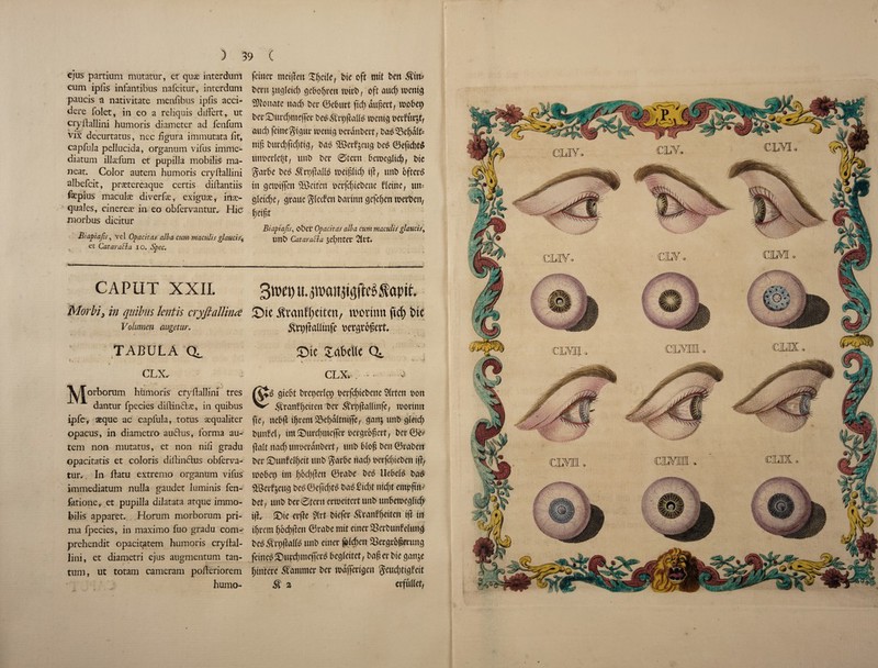 ejus partium mutatur, et quae interdum feinet* meifTett £f)ctle, t>ie oft mtt t>en ^itt? cum iplis infantibus nafcitur, interdum paucis a nativitate menfibus ipfis acci- dere folet, in eo a reliquis differt, ut cryflallini hum oris diameter ad fenfum vix decurtatus, nec hgura immutata fit, capfiila pellucida, organum vifus imnie- diatum illaefum et pupilla mobile ma- neat. Color autem humoris cryflallini albefcit, praetereaque certis diflantiis fepius maculae diverge, exiguae, inae- quales, cinereae in eo obfervantur. Hie- morbus dicitur Biapiajts, vel Op ac it as alba cum maculis glaucis^ . ct QataraHa io. Spec. h - - . - - - - . CAPUT XXII. Morbiy in qnibm lentis cryftaltind Volumen augetur. TABULA Qa. t % . • • CLX. ; ^Jorborum htimoris cryflallini tres dantur fpecies diflinclae, in quibus ipfe, *que ac capfula, toms aequaliter opacus, in diametro audlus, forma au¬ tem non mutatus, et non nifi gradu opacitatis et coloris diflinctus obferva- tur. In flatu extremo organum vifus immediatum nulla gaudet luminis fen- fatione, et pupilla dilatata atque immo- bilis apparet. Horum morborum pri- ma fpecies, in maximo fuo gradu com¬ prehends opacitatem humoris cryflal¬ lini, et diametri ejus augmentum tan- tum, ut totam cameram poileriorem humo- Ocm jucjfetef) gefcofjrett twO, oft aud) rcenicj SRonate trad) Ocr ©e&urt fid) dufkvt, roofcet) Oa4Surcf>me(fer ri)|M3 mn oetfurjt, aud) fdne§t$ur mm# oerdnOctt, t>a$33eljd(fc nig t)urd)fuf)tt^ SBcrf^eug 0efid)t$ unoerle^t, unt> Oer ©tern Oemegltd), t>ie garbe t>e$ SfrpjlalK seif ltd) iff, unb 6ftet$ in getpificn ®ctfcrt ocrfcfteOette Heine, un= gleidje, graue Sweden Davtnn gefefjen toerOen, fjet ft Biapiajis, obct’ Opacitas alba cum maculis glaucisy imb Cataracla $cl)ntet VltU 3twt) u. fapit £)tc ^tantyeiten, wortnn fid) i>ie &n,ftal(tiife vcrgioBet't. JDie Xabcttc CL v *. *'r * CLX» . d giebt i5vct)ci'lci) betfdiiebetic illicit son .<)lranH)cifctt bet <^ri)ftallinfe, roorinit ftc, ttcbft intent ISegaitniffe, ganj unb gleid) bimfel, im©urd>meffer eergeogert, bcr©e-j jlalt rtacfj unsetdnbect, unb blog ben ©vabeit bet' Sunfeiffeit unb $arbe riadf beifdjieben iff, toobet) ini f)bci)ffen ©robe bed Uebclb bad aBcrfjcug bcd@cfic()td bae£id)t ntdft empgtt= bet, unb ber Stern erroeitert unb unbetseglicf? i|i Sic etfe ?ivt biefer ,fvanff)etten ift in ifjrern f)bd)ftcu ©rabe mit einec SBeibimfeiung beo ^I'pffalfe unb einer foidx’it 58ergr6§mmg feineoSutdjmeiTcrb begteitet, bag erbie ganje (jinlere hammer ber wdjferigcn geud;tigfeit & 2 ccfilllct,