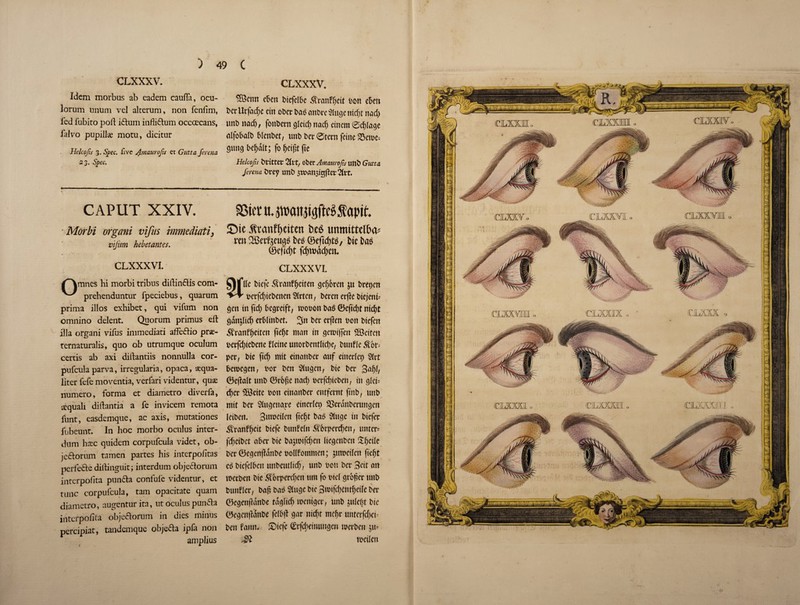 CLXXXV. Idem morbus ab eadem caufla, ocu- lorum unum yel alterum, non fenfim, led fubito poll idum infliftum occcecans, falvo pupill# motu, dicitur Helcofis 3. Spec, five Amaurofis et Gutta ferena 2 3. Spec. CLXXXV. SBcmt eSctt btefclbe ^ranfljeit bon e5eti bet* Urfadjc cin ober unbre $Iuge nttfjt nad) tint) nadj, fonbern gfeid> nad; einem @d;fage ctlfobalt) 6lent>et/ unt) t>ei* 0tern feme 23en>e= gung be^dlt; jo !jeipt fie Helcofis bvitter Qltt, ober Amaurofis unb Gutta ferena brey unb $wansie$ftcr CAPUT XXIV. ■ Morbi organi vifits hmnediati, vijinn hebetantes. SSier u4tt>atuujjM $apit. £)ie $t4anff)eiten unmittelfca* ttn2Betf$eug$t>e$©e<td;t$, i>ic ©c|lct)t fd)tt)ad;eiu CLXXXVI. mnes hi morbi tribus diftin&is com- prehenduntur fpeciebus, quarum prima illos exhibet, qui vifum non omnino delent. Quorum primus eft ilia organi vifus inimediati affe&io prae¬ ternaturalis, quo ob utrumque oculum certis ab axi diftantiis nonnulla cor- pufcula parva, irregularia, opaca, aequa- liter fefe moventia, verfari videntur, quae numero, forma et diametro diverfa, sequali diftantia a fe invicem remota funt, easdemque, ac axis, mutationes fubeunt. In hoc morbo oculus inter- dum hcec quidem corpufcula videt, ob- jeftoriun tamen partes his interpofitas perfe&e diftinguit; interdum objedorum interpofita pun&a confute videntur, et tunc corpufcula, tarn opacitate quam diametro, augentur ita, ut oculus pun&a interpofita objeclorum in dies minus pcrcipiat, tandemque obje&a ipfa non amplius CLXXXVI. _ * ; ... „ ' **. * tfe biefe Srmtfljeiten gcf;6ren ju brepen oerfd;iebenen Slrten, beren etftc biejettb gen in fid; begreift, n>ooon ba$ ©efiebt nid)t gdn&licfj erblinbet btt etfen Don biefen ^ranffjeiteit fiefjt man in geiDijfen BScitcn berfd;icbene Heine unorbentlidje, bunfle Sor= per, bie fid; mtt einanber auf einerfep 5(it bcnxgen, oor ben 2lugen, bie ber 3^/ ©ejkft unb ©rbf;e nad; Derfdrieben, in glef djer ®ctte Don einanber entfernt finb, unb mit ber Siugettaye eincrlep Serdnberungen letbett, Sweden fiefjt bu$ $(uge in biefer ^vranffjcit biefe bunfefn ^6rperd)eit r tinted fd;ett>ct abet* bie bajn>ifd;en liegcnbeit itfjeile ber ©egenjlartbe oolffommen; jttroeifen fiefjt c$ biefclbcit ttnbeutfid;, unb bon ber 3eit ait merben bie $&rperd;cn tim fo Did grbjier unb bunffer, baf; ba$ 2tuge bie 3toifcf)entfjeife ber ©ecjenjldnbe tdqlic^ roeniger, unb ^ulegt bie ©egenjfiSnbe fclbjl gar nidjt mcf)r untcrfcl>cr- ben faint# Siefc grfd;eimmgeu merben ju* ,$l toeilen