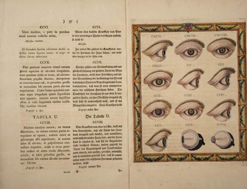 CCVI. Idem morbus, a pure in partibus oculi intends colledto ortus, Abfiejfus vocatur. Ad fecundam fpeciem referuntur morbi, in quibus cornea figuram mutat, et magis vel minus elcvata obfervatur. CCVII. Hue pertinet maximae centri corner partis opacitas et elevatio irregularis, cum partium iridis et uveae, ad circum- ferentiam pupillae fitarum, disruptione et commixtione tali, ut priorfum prelfae et immediate Tub corneae parte elevatae reperiantur. Color hujus opacitatis cor¬ ner aeque irregularis quam fuperficies ejus apparet, interim tamen faepidime albus et vafis fanguineis cindtus exiftit. Hie morbus vocatur Proptojis I. Spec. TABULA U. CCVIII. Morbus ejusdem naturae, eo tamen diferimine, ut omnes corneae partes ir- regulares et opacae, coloris mixti et plerumque albi reperiantur, et cornea adeo fit elevata, ut palpebrarum con- taclum impediat; iridis et uve* parti¬ bus eodem ut antea modo dilaceratis, mixtis, et adeo priorfum prefiis, ut immediate fub cornea elevata invenian- tur: Dicitur Proptofti 2. Spec. CCVI. SSenn eben biefelbe 5?ranfgeit i>on ©ter tit ben inmenbicjenXgeilen bebSiugeb entgegt, fo geigt fie Abfcejfut. But jrooten $(tt gegoren bie £ranfgeiten, woxt inn bie ,£orngcmt igre gigut dnbett, wnb megc obet ivenigec in bie $oge tritt. CCVII. Merger gegbrt cine ffierbunfelung uttb un* gleicge(£rgogung beb grbgtenXgeilbber3)fitte berJporngaut, nebg einerBerreigung unb fob d;en93ermifcgung ber imtlmfangebeb@ternb begnbltdjenXgeile beb fRegenbogcnb unbSrau* bengdutleinb, bag man fie born unmittelbar unter ber ergbgeten Jporngaut gnbet. £)ic Sunfelgeit ber iporngaut ift bon eben fo irre? guldrer garbe, alb igre £)bergad;e irregular ig; bod) ft'egt fie megrentgeilb weig, nnb ig mit SSlutgefagen umgeben. SDiefe ranffjeit ^etgt Proptofis erfter Qivt* £ie ZabtUc U. CCVIII. ©ne^ranfgeitbon eben ber^lrt, boeg mit bem Unterfdgebe, bag alle Xgeile ber foorn= gaut irregular unb bunfel, bon bermtfd)terf megrentgeilb rneiger garbe ft'nb, unb bie #orn* gaut fo ergaben ig, bag fid) bie Slugettlieber nid)t berugren fbnnen; mobei) $ugletcg^bie Xgeile beb Svegenbogenb unb £raubengdut= ^enb eben fo, rote borgin, serriffen, bermifegt, unb fo bormdrtb gebrueft finb, bag fie ttnroifc tclbar unter ber ergbgeten £orngaut gefunbett roerben, geigt Proptofa $\voter 3ftt. Morbi
