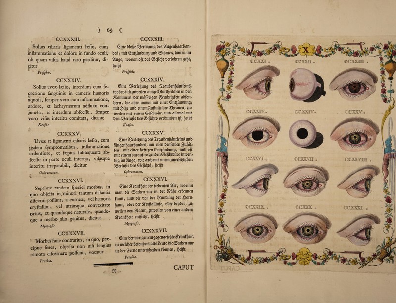 } 6J C CCXXXIII. # - •’ Solius ciliaris ligamenti Ise/io, cum inflammatione et dolore in fundo oculi,* ♦ % ob quam vifus haud raro perditur, di- pitur Projphif. > CCXXXIV. Solius uveae-lxfio, intcrdum cum Te- cretione fanguinis in cameris humqris aquoli, Temper vero cum inflammatione, ardore, et lachrymarum adfluxu con- jun&a, et interdum abfceflfu, Temper vero viTus interim comitata, dicitui; Keafos. 4. ' ccxxxv. Uveae et ligamenti ciliaris laefio, cum iisdem Tymptomatibus, inflammatione ardentiore, et fepius TubTequente ab- fceflu in parte oculi interna, viTusque interim irreparabili, dicitur Ochyomatoti. CCXXXVI. Scptimae tandem Tpeciei morbus, in quo obje&a in/minori tantum diflantia difcerni poflimt, a corner, vel humons cryftallini, vel utriusque convexitate ortus, et quandoque naturalis, quando- que a mprbo alio genitus, dicitur Myopia/if. ccxxxvii. : Morbus huic contrarius, in quo, prai- cipue fenes, objecla non nifi longius remota difcernere poflunt, vocatur Presbia. CCXXXIII. ^ ' ■ 'f rf * ,«» ... .... (£ine 6foge 5$etle|tmg be$ ^(uc^en^aar^an- v 4, .<t» beg} mit Sntptbung tmb 0cl)mer$ fjinten im ^lugc, roooon oft ba$ 0eftd)t ocrlo^vcn <je(jt, f;eij3t ‘ Profphis. • * CCXXXIV, » % (Eine 93erle$tmg beS XraubenfjautleinS, mobet; ftcf; ^umeileit einige^Muttljeilcben in belt ^ammern ber ma|feri§en geuc!;tiqfett abfom bent, t>te abet* immer mit enter (Ent&unbun<j* mit£i|e tmb einemSufU# berXljrdnen, ju- meilett mit einent 0efd)mur, ttnb allemal mit bem 23erluj*e be$ 0eftd)t$ oerbunben iji, Ijeigt Keafos. p * w at ccxxxv; ©ne S3erie|ttng bes XnjubenfjdutletnS unt> SfogenljaarbanbeS, mit ebeit Oenfelben Bufab len, miteinerfjeftigen©it5tmbung, ttnb oft mit einent bavauf fo(genben®efd)rcmre inroen* big tmSfuge, roic aud; mit emem unetfe|Ud)en Saiufte bed ©eftd)tS, ijeijjt *i ' •* Ochromaton. ccxxxvi. j ©ne Sranfljcit bee ftebentett Sift, tnoriutt man bte ®ad)enmir in bee 9Jdlje eefennett fann, unb bte non ber 35unbung bee £crm ^aut, oberberS'rpfMinfe, ober better, }tt? metieit non 9Jatur, jmuetlen son enter aitbeni ^ranfijeit ent|Ief)t; Ijeipt . Myofiajis. CCXXXVII. ' ©tteberborigen entgegengefc|te5fran!^eit, in n>efd)er befonbers aite£cntc bic@ad)en nut in ber Sente unterfd;eibeu fottnett, fjeifst Presbia. •* CAPUT