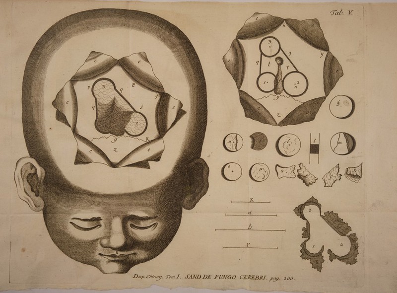 ■T ' JDtsp.C/urtuy. 'Tem.1. SANI) DE FUNGO CEREBRI. jcury. 2 00,