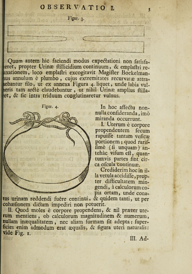 Figur. 3. 3 [ Quum autem hic faciendi modus expeftationi non fatisfa- teret, propter Urinae ftillicidium continuum, & emplaftri re- axationem, loco emplaftri excogitavit Magifter Boekelman- ius annulum 6 plumbo, cujus extremitates recurvatae attra- lebantur filo, ut ex annexa Figura 4. liquet, unde labia vul- leris tam arfte claudebantur, ut nihil Urinae amplius ftilla- et, & fic intra triduum conglutinaretur vulnus. F:gur- 4- In hoc affedtu non¬ nulla confideranda, imo miranda occurrunt. I. Uterum e corpore propendentem fecum rapuifte tantam veficae portionem; quod rarif- fimd (fi unquam) an¬ tehac vifumeft, quan¬ tumvis partes fint cir¬ ca ofcula continuae. Crediderim hoc in il¬ la vetula accidifle, prop¬ ter difficultatem min¬ gendi, a calculorum co¬ pia ortam, unde cona¬ tus urinam reddendi fuere continui, & quidem tanti, ut per cohaefionem didtam impediri non potuerit. II. Quod moles e corpore propendens, & nil praeter ute¬ rum mentiens, ob calculorum magnitudinem & numerum, nullam inaequalitatem, nec aliam formam fit adepta; fuper- ficies enim admodum erat aequalis, & figura uteri naturalis: vide Fig. 1.