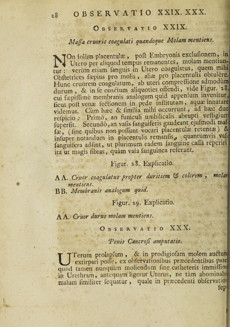 Observatio XXIX. Majfa cruoris coagulati quandoque Molant mentiens. | NOn (olam placentulae , poft Embryonis exclufionem, in Utero per aliquod tempus remanentes, molam mentiun¬ tur : verum etiam fanguis in Utero coagulatus, quem mihi Obftetrices fepius pro molis , aliae pro placentulis obtulere. Hunc cruorem coagulatum, ab uteri cqmpreflione admodum durum, & in fe coaftum aliquoties offendi, vide rigur.'20, cui faepiflime membranis analogum quid appenlum invenitur, ficut polt venae feftionem in pede inftitutam, aquae innatare videmus. Cum haec & fimilia mihi occuirunt, ad hctc duo, relpicio ,* Primo, an funiculi umbilicalis abiup.ti veitigiuni; fuperfit. Secundo,an vafis fanguiferis gaudeant ejufmodi maf| fae, (fine quibus non poliunt vocari placentulse retentae) & infuper notandum in placentulis remanfis,, quantumvis vafi; fanguifera adfint, ut plurimum eadem languine calla reperiri ita ut magis fibras, quam vata fanguinea referant. Figur. z 8. Explicatio. A A. Cruor coagulatus propter duritiem, & colorem , molat mentiens. BB. Membranis analogum quid. Figur. z$>. Explicatio. A A. Cruor durus molam mentiens. Observatio XXX. j Tenis Cancrojl amputatio. : UTerum prolapfum , & in prodigiofam molem auftunl extirpari polTe, ex obfervationibus praecedentibus pater quod tamen nunquam moliendum fine catheteris immiifioil in Urethram, antequam ligetur Uterus, ne tam abominabi| malum fimiliter fequatur , quale in praecedenti obfervatioi fep|
