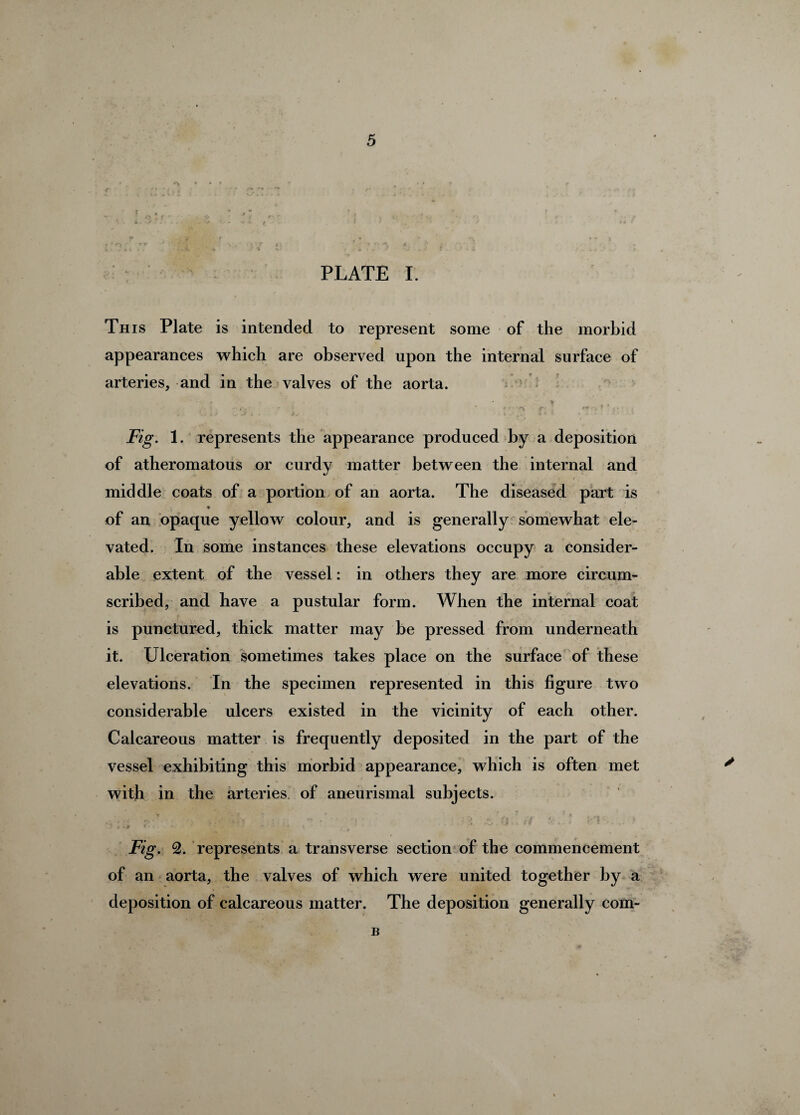 PLATE I. This Plate is intended to represent some of the morbid appearances which are observed upon the internal surface of arteries, and in the valves of the aorta. * j • r- ! *! •. * < Fig. 1. represents the appearance produced by a deposition of atheromatous or curdy matter between the internal and middle coats of a portion of an aorta. The diseased part is of an opaque yellow colour, and is generally somewhat ele¬ vated. In some instances these elevations occupy a consider¬ able extent of the vessel: in others they are more circum¬ scribed, and have a pustular form. When the internal coat is punctured, thick matter may be pressed from underneath it. Ulceration sometimes takes place on the surface of these elevations. In the specimen represented in this figure two considerable ulcers existed in the vicinity of each other. Calcareous matter is frequently deposited in the part of the vessel exhibiting this morbid appearance, which is often met with in the arteries of aneurismal subjects. A lyti ^ < *: - *|yBU ■ * ♦ i * * Fig. 2. represents a transverse section of the commencement of an aorta, the valves of which were united together by a deposition of calcareous matter. The deposition generally com- B