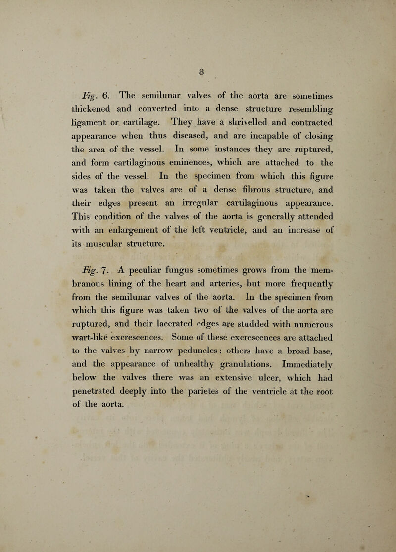 Fig. 6. The semilunar valves of the aorta are sometimes thickened and converted into a dense structure resembling ligament or cartilage. They have a shrivelled and contracted appearance when thus diseased, and are incapable of closing the area of the vessel. In some instances they are ruptured, and form cartilaginous eminences, which are attached to the sides of the vessel. In the specimen from which this figure was taken the valves are of a dense fibrous structure, and their edges present an irregular cartilaginous appearance. This condition of the valves of the aorta is generally attended with an enlargement of the left ventricle, and an increase of its muscular structure. - .. . 1 Fig. 7- A peculiar fungus sometimes grows from the mem¬ branous lining of the heart and arteries, but more frequently from the semilunar valves of the aorta. In the specimen from which this figure was taken two of the valves of the aorta are ruptured, and their lacerated edges are studded with numerous wart-like excrescences. Some of these excrescences are attached to the valves by narrow peduncles: others have a broad base, and the appearance of unhealthy granulations. Immediately below the valves there was an extensive ulcer, which had penetrated deeply into the parietes of the ventricle at the root of the aorta.