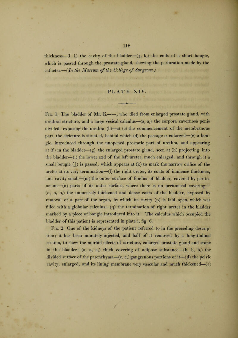 thickness—(i, i,) the cavity of the bladder—(j, k,) the ends of a short bougie, which is passed through the prostate gland, shewing the perforation made by the catheter.—(In the Museum of the College of Surgeons.) PLATE XIV. Fig. 1. The bladder of Mr. K-, who died from enlarged prostate gland, with urethral stricture, and a large vesical calculus—(a, a,) the corpora cavernosa penis divided, exposing the urethra (b)—at (c) the commencement ol the membranous part, the stricture is situated, behind wdiich (d) the passage is enlarged—(e) a bou¬ gie, introduced through the unopened prostatic part of urethra, and appearing at (f) in the bladder—(g) the enlarged prostate gland, seen at (h) projecting into the bladder—(i) the lower end of the left ureter, much enlarged, and through it a small bougie (j) is passed, which appears at (k) to mark the narrow orifice of the ureter at its very termination—(1) the right ureter, its coats of immense thickness, and cavity small—(m) the outer surface of fundus of bladder, covered by perito¬ naeum—(n) parts of its outer surface, where there is no peritonseal covering— (o, o, o,) the immensely thickened and dense coats of the bladder, exposed by removal of a part of the organ, by which its cavity (p) is laid open, which was filled with a globular calculus—(q) the termination of right ureter in the bladder marked by a piece of bougie introduced into it. The calculus which occupied the bladder of this patient is represented in plate i, fig. 6. Fig. 2. One of the kidneys of the patient referred to in the preceding descrip¬ tion ; it has been minutely injected, and half of it removed by a longitudinal section, to shew the morbid effects of stricture, enlarged prostate gland and stone in the bladder—(a, a, a,) thick covering of adipose substance—(b, b, b,) the divided surface of the parenchyma—(c, c,) gangrenous portions of it—(d) the pelvic cavity, enlarged, and its lining membrane very vascular and much thickened—(e)