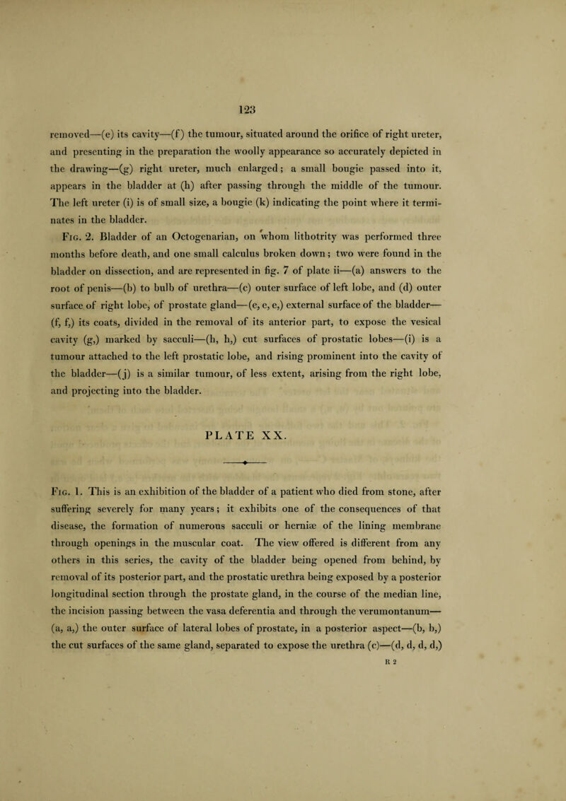 removed—(e) its cavity—(f) the tumour, situated around the orifice of right ureter, and presenting in the preparation the woolly appearance so accurately depicted in the drawing—(g) right ureter, much enlarged ; a small bougie passed into it, appears in the bladder at (h) after passing through the middle of the tumour. The left ureter (i) is of small size, a bougie (k) indicating the point where it termi¬ nates in the bladder. Fig. 2. Bladder of an Octogenarian, on whom lithotrity was performed three months before death, and one small calculus broken down; two were found in the bladder on dissection, and are represented in fig. 7 of plate ii—(a) answers to the root of penis—(b) to bulb of urethra—(c) outer surface of left lobe, and (d) outer surface of right lobe, of prostate gland—(e, e, e,) external surface of the bladder— (f, f,) its coats, divided in the removal of its anterior part, to expose the vesical cavity (g,) marked by sacculi—(h, h,) cut surfaces of prostatic lobes—(i) is a tumour attached to the left prostatic lobe, and rising prominent into the cavity of the bladder—(j) is a similar tumour, of less extent, arising from the right lobe, and projecting into the bladder. PLATE XX. -♦- Fig. 1. This is an exhibition of the bladder of a patient who died from stone, after suffering severely for many years; it exhibits one of the consequences of that disease, the formation of numerous sacculi or herniae of the lining membrane through openings in the muscular coat. The view offered is different from any others in this series, the cavity of the bladder being opened from behind, by removal of its posterior part, and the prostatic urethra being exposed by a posterior longitudinal section through the prostate gland, in the course of the median line, the incision passing between the vasa deferentia and through the verumontanum— (a, a,) the outer surface of lateral lobes of prostate, in a posterior aspect—(b, b,) the cut surfaces of the same gland, separated to expose the urethra (c)—(d, d, d, d,) R 2