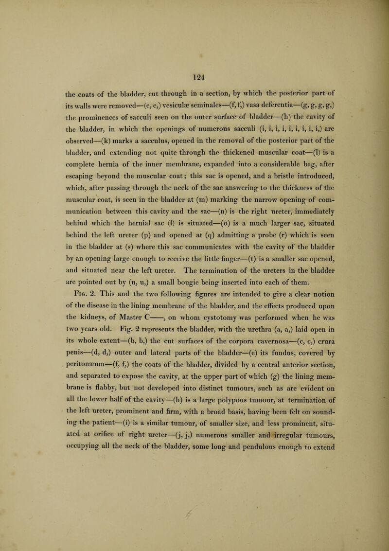 the coats of the bladder, cut through in a section, by which the posterior part of its walls were removed—(e, e,) vesiculse seminales—(f, f,) vasa deferentia—(g, g, g, g,) the prominences of sacculi seen on the outer surface of bladder—(h) the cavity of the bladder, in which the openings of numerous sacculi (i, i, i, i, i, i, i, i, i,) are observed—(k) marks a sacculus, opened in the removal of the posterior part of the bladder, and extending not cpiite through the thickened muscular coat—(1) is a complete hernia of the inner membrane, expanded into a considerable bag, after escaping beyond the muscular coat; this sac is opened, and a bristle introduced, which, after passing through the neck of the sac answering to the thickness of the muscular coat, is seen in the bladder at (m) marking the narrow opening of com¬ munication between this cavity and the sac—(n) is the right ureter, immediately behind which the hernial sac (1) is situated—(o) is a much larger sac, situated behind the left ureter (p) and opened at (q) admitting a probe (r) which is seen in the bladder at (s) where this sac communicates with the cavity of the bladder by an opening large enough to receive the little finger—(t) is a smaller sac opened, and situated near the left ureter. The termination of the ureters in the bladder are pointed out by (u, u,) a small bougie being inserted into each of them. Fig. 2. This and the two following figures are intended to give a clear notion of the disease in the lining membrane of the bladder, and the effects produced upon the kidneys, of Master C-, on whom cystotomy was performed when he was two years old. Fig. 2 represents the bladder, with the urethra (a, a,) laid open in its whole extent—(b, b,) the cut surfaces of the corpora cavernosa—(c, c,) crura penis—(d, d,) outer and lateral parts of the bladder—(e) its fundus, covered by peritonaeum—(f, f,) the coats of the bladder, divided by a central anterior section, and separated to expose the cavity, at the upper part of which (g) the lining mem¬ brane is flabby, but not developed into distinct tumours, such as are evident on all the lower half of the cavity—(h) is a large polypous tumour, at termination of the left ureter, prominent and firm, with a broad basis, having been felt on sound¬ ing the patient—(i) is a similar tumour, of smaller size, and less prominent, situ¬ ated at orifice of right ureter—(j, j,) numerous smaller and irregular tumours, occupying all the neck of the bladder, some long and pendulous enough to extend