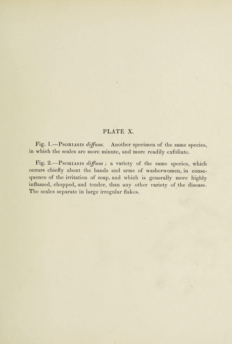 Pig. 1.—Psoriasis diffusa. Another specimen of the same species, in which the scales are more minute, and more readily exfoliate. Fig. 2.—Psoriasis diffusa ; a variety of the same species, which occurs chiefly about the hands and arms of washerwomen, in conse¬ quence of the irritation of soap, and which is generally more highly inflamed, chopped, and tender, than any other variety of the disease. The scales separate in large irregular flakes.